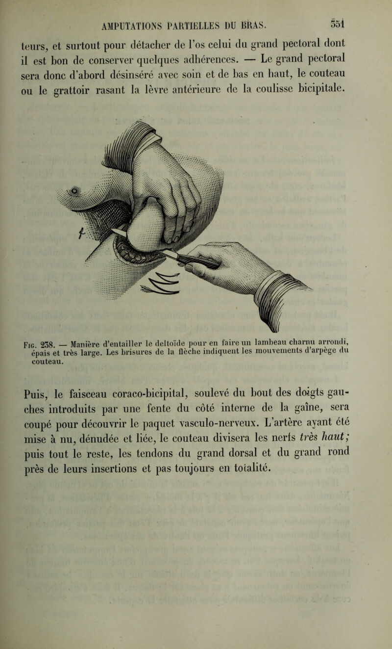 leurs, et surtout pour détacher de l’os celui du grand pectoral dont il est bon de conserver quelques adhérences. — Le grand pectoral sera donc d’abord désinséré avec soin et de bas en haut, le couteau ou le grattoir rasant la lèvre antérieure de la coulisse bicipitale. Fig. 238. — Manière d'entailler le deltoïde pour en faire un lambeau charnu arrondi, épais et très large. Les brisures de la flèche indiquent les mouvements d’arpège du couteau. Puis, le faisceau coraco-bicipital, soulevé du bout des doigts gau- ches introduits par une fente du côté interne de la gaine, sera coupé pour découvrir le paquet vasculo-nerveux. L artere ayant été mise à nu, dénudée et liée, le couteau divisera les nerls très haut; puis tout le reste, les tendons du grand dorsal et du grand rond près de leurs insertions et pas toujours en totalité.