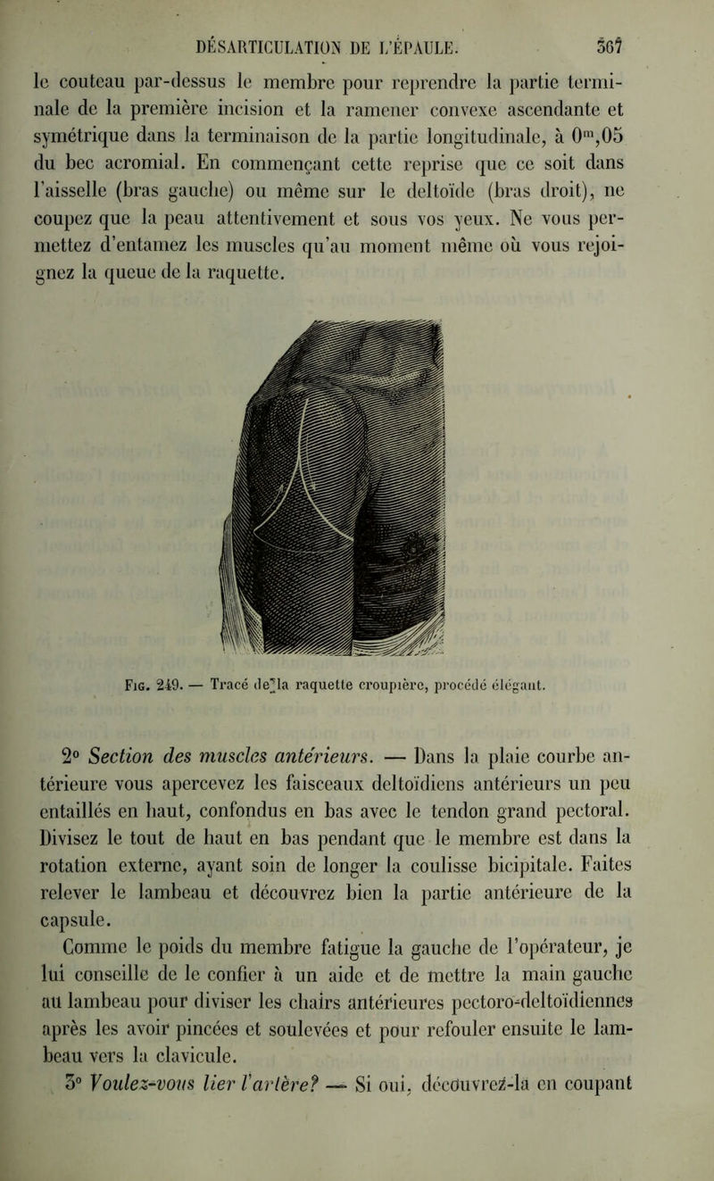 le couteau par-dessus le membre pour reprendre la partie termi- nale de la première incision et la ramener convexe ascendante et symétrique dans la terminaison de la partie longitudinale, à 0*^^,05 du bec acromial. En commençant cette reprise que ce soit dans Faisselle (bras gauche) ou même sur le deltoïde (bras droit), ne coupez que la peau attentivement et sous vos yeux. Ne vous per- mettez d’entamez les muscles qu’au moment même où vous rejoi- gnez la queue de la raquette. Fig. 249. — Tracé tle^la raquette croupière, procédé élégant. 2® Section des muscles antérieurs. — Dans la plaie courbe an- térieure vous apercevez les faisceaux deltoïdiens antérieurs un peu entaillés en haut, confondus en bas avec le tendon grand pectoral. Divisez le tout de haut en bas pendant que le membre est dans la rotation externe, ayant soin de longer la coulisse bicipitale. Faites relever le lambeau et découvrez bien la partie antérieure de la capsule. Comme le poids du membre fatigue la gauche de l’opérateur, je lui conseille de le confier à un aide et de mettre la main gauche au lambeau pour diviser les chairs antérieures pectoro-deltoïdiennes après les avoir pincées et soulevées et pour refouler ensuite le lam- beau vers la clavicule. 3° yoïdez-'VOiis lier tarière? — Si oui, décduvrez-la en coupant