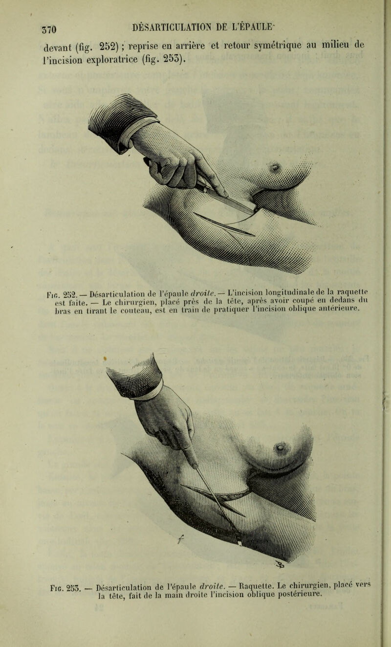 devant (fig. 252) ; reprise en arrière et retour symétrique au milieu de l’incision exploratrice (fig. 253). Fia 252 — Désarticulation de l’épaule droiife. — L’incision longitudinale de la racpiette est faite. — Le chirurgien, placé près de la tète, après avoir coupé eu dedans dn liras en tirant le couteau, est en train de praticpier l’incision oblique anterieure. Fig. 253 ~ Désarticulation de l’épaule droite. — Raquette. Le chirurgien, placé vers la tête, fait de la main droite l’incision oblique postérieure.