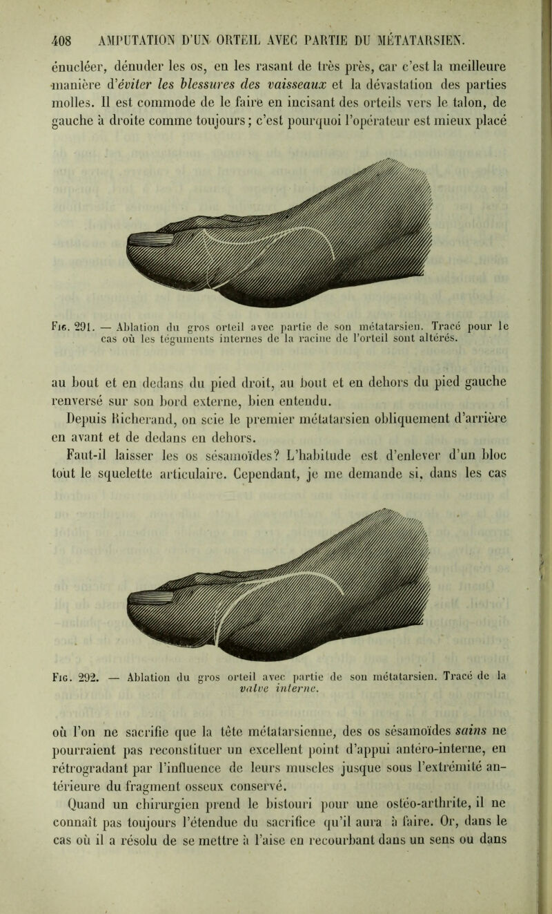 énucléer, dénuder les os, en les rasant de très près, car c’est la meilleure •manière à'éviter les blessures des vaisseaux et la dévastation des parties molles. 11 est commode de le faire en incisant des orteils vers le talon, de gauche a droite comme toujours ; c’est pourquoi l’opérateur est mieux placé Fjc. 291. — Ablation du gros orteil avec partie de son métatarsien. Tracé pour le cas où les téguiuents internes de la racine de l’orteil sont altérés. au bout et en dedans du pied droit, au bout et en dehors du pied gauche renversé sur son bord externe, bien entendu. Depuis hicherand, on scie le premier métatarsien obliquement d’arrière en avant et de dedans en dehors. Faut-il laisser les os sésanioïdes? L’habitude est d’enlever d’un bloc tout le squelette articulaire. Cependant, je me demande si, dans les cas Fig. 292. — Ablation du gros orteil avec j)ai'tie de sou métatarsien. Tracé de la valve, interne. OÙ l’on ne sacrifie que la tète métatarsienne, des os sésamoïdes sains ne pourraient pas reconstituer un excellent point d’appui antéro-interne, en rétrogradant par l’influence de leurs muscles jusque sous l’extrémité an- térieure du fragment osseux conservé. Quand un chirurgien prend le bistouri pour une ostéo-artlirite, il ne connaît pas toujours l’étendue du sacrifice qu’il aura à faire. Or, dans le cas où il a résolu de se mettre à l’aise en recourbant dans un sens ou dans