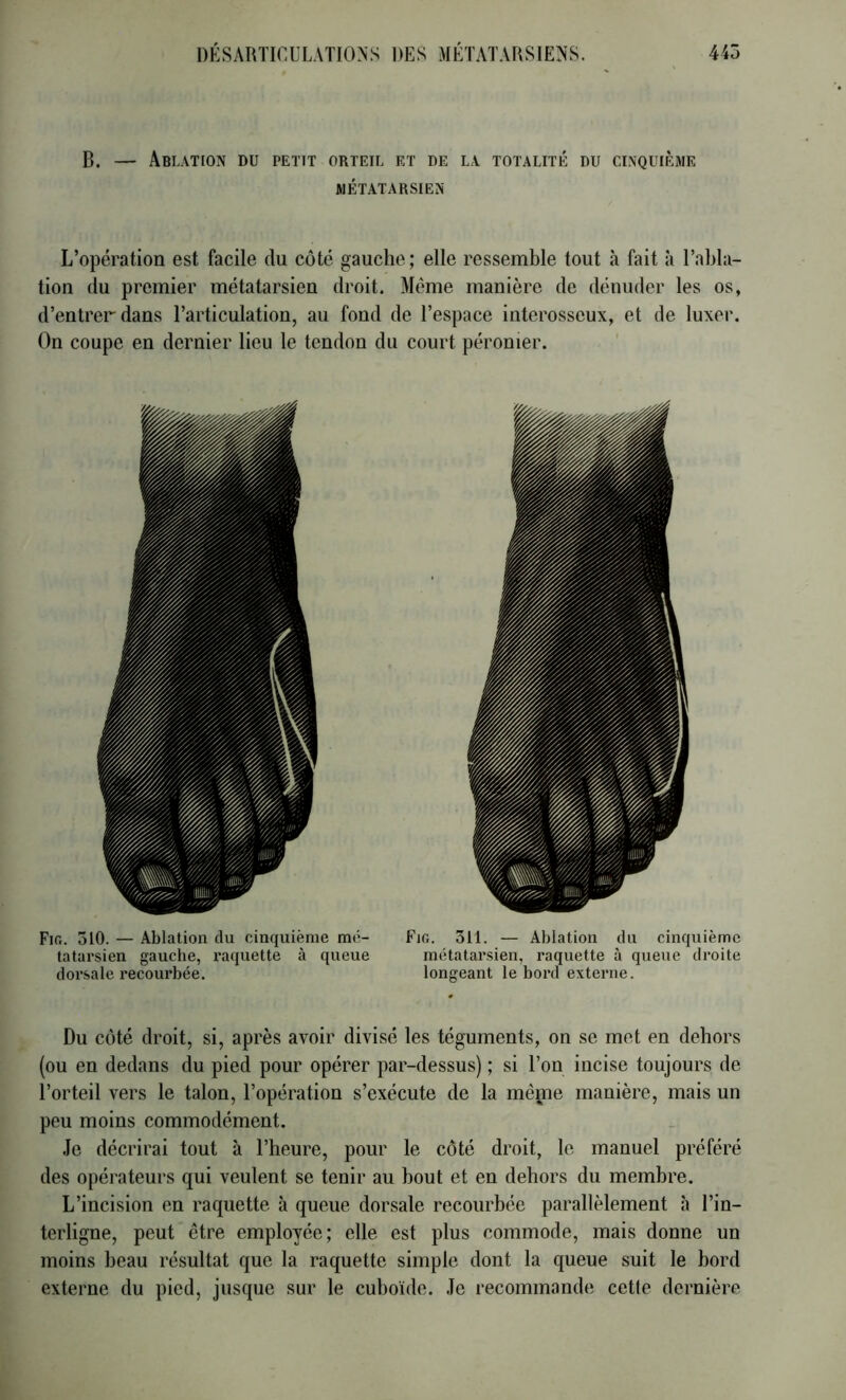 B. — Ablation du petit orteil et de la totalité du cinquième MÉTATARSIEN L’opération est facile du côté gauche; elle ressemble tout à fait à l’abla- tion du premier métatarsien droit. Même manière de dénuder les os, d’entrer dans l’articulation, au fond de l’espace interosseux, et de luxer. On coupe en dernier lieu le tendon du court péronier. Fia. 310. — Ablation du cinquième mé- Fio. 311. — Ablation du cinquième tatarsien gauche, raquette à queue métatarsien, raquette à queue droite dorsale recoui'bée. longeant le bord externe. Du côté droit, si, après avoir divisé les téguments, on se met en dehors (ou en dedans du pied pour opérer par-dessus) ; si l’on incise toujours de l’orteil vers le talon, l’opération s’exécute de la même manière, mais un peu moins commodément. .le décrirai tout à l’heure, pour le côté droit, le manuel préféré des opérateurs qui veulent se tenir au bout et en dehors du membre. L’incision en raquette à queue dorsale recourbée parallèlement à l’in- terligne, peut être employée; elle est plus commode, mais donne un moins beau résultat que la raquette simple dont la queue suit le bord externe du pied, jusque sur le cuboïde. .le recommande cette dernière