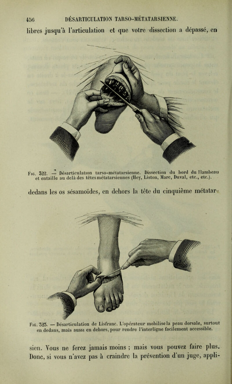 libres jusqu’à l’articulation et que votre dissection a dépassé, en Fig. 322. — Désarticulation tarso-métatarsienne. Dissection du bord du I lambeau et entaille au delà des têtes métatarsiennes (Hey, Liston, Marc, Duval, etc., etc.). dedans les os sésamoïdes, en dehors la tête du cinquième métatar - Fig. 523. — Désarticulation de Lisfranc. L’opérateur mobilise la peau dorsale, surtout en dedans, mais aussi en dehors, pour rendre l’interligne facilement accessible. sien. Vous ne ferez jamais moins ; mais vous pouvez faire plus. Donc, si vous n’avez pas à craindre la prévention d un juge, appli-