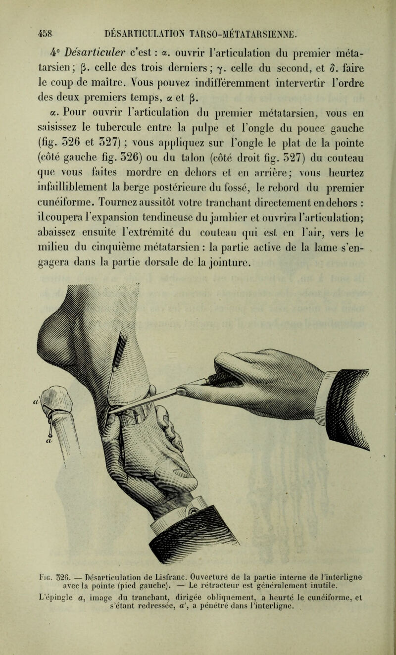 4® Désarticuler c’est : a. ouvrir l’articulation du premier méta- tarsien; p. celle des trois derniers; y- celle du second, et faire le coup de maître. Vous pouvez indifféremment intervertir l’ordre des deux premiers temps, a et |i. a. Pour ouvrir l’articulation du premier métatarsien, vous en saisissez le tubercule entre la pulpe et l’ongle du pouce gauche (fig. o26 et 527) ; vous appliquez sur l’ongle le plat de la pointe (côté gauche fig. 526) ou du talon (côté droit fig. 527) du couteau que vous faites mordre en dehors et en arrière; vous heurtez infailliblement la berge postérieure du fossé, le rebord du premier cunéiforme. Tournez aussitôt votre tranchant directement en dehors : il coupera l’expansion tendineuse du jambier et ouvrira l’articulation; abaissez ensuite l’extrémité du couteau qui est en l’air, vers le milieu du cinquième métatarsien : la partie active de la lame s’en- gagera dans la partie dorsale de la jointure. Fig. 526. — Désarticulation de Lisfranc. Ouverture de la partie interne de l’interligne avec la pointe (pied gauche). — Le rétracteur est généralement inutile. L’épingle a, image du tranchant, dirigée obliquement, a heurté le cunéiforme, et s’étant redressée, a', a pénétré dans l’interligne.