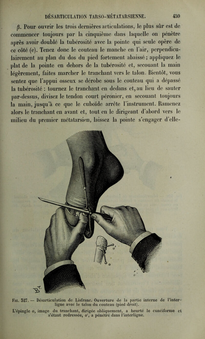 |3. Pour ouvrir les trois dernières articulations, le plus sûr est de commencer toujours par la cinquième dans laquelle on pénètre après avoir doublé la tubérosité avec la pointe qui seule opère de ce côté (e). Tenez donc le couteau le manche en Pair, perpendicu- lairement au plan du dos du pied fortement abaissé ; appliquez le plat de la pointe en dehors de la tubérosité et, secouant la main légèrement, faites marcher le tranchant vers le talon. Bientôt, vous sentez que l’appui osseux se dérobe sous le couteau qui a dépassé la tubérosité : tournez le tranchant en dedans et, au lieu de sauter par-dessus, divisez le tendon court péronier, en secouant toujours la main, jusqu’à ce que le cuboïde arrête l’instrument. Ramenez alors le tranchant en avant et, tout en le dirigeant d’abord vers le milieu du premier métatarsien, laissez la pointe s’engager d’ellc- Fig. 327. — Désarticulation de Lisfi*anc. Ouverture de la partie interne de l’intei*- ligne avec le talon du couteau (pied droit). L’épingle o, image du tranchant, dirigée obliquement, a heurté le cunéiforme et s'étant redressée, o’, a pénétré dans l’interligne.