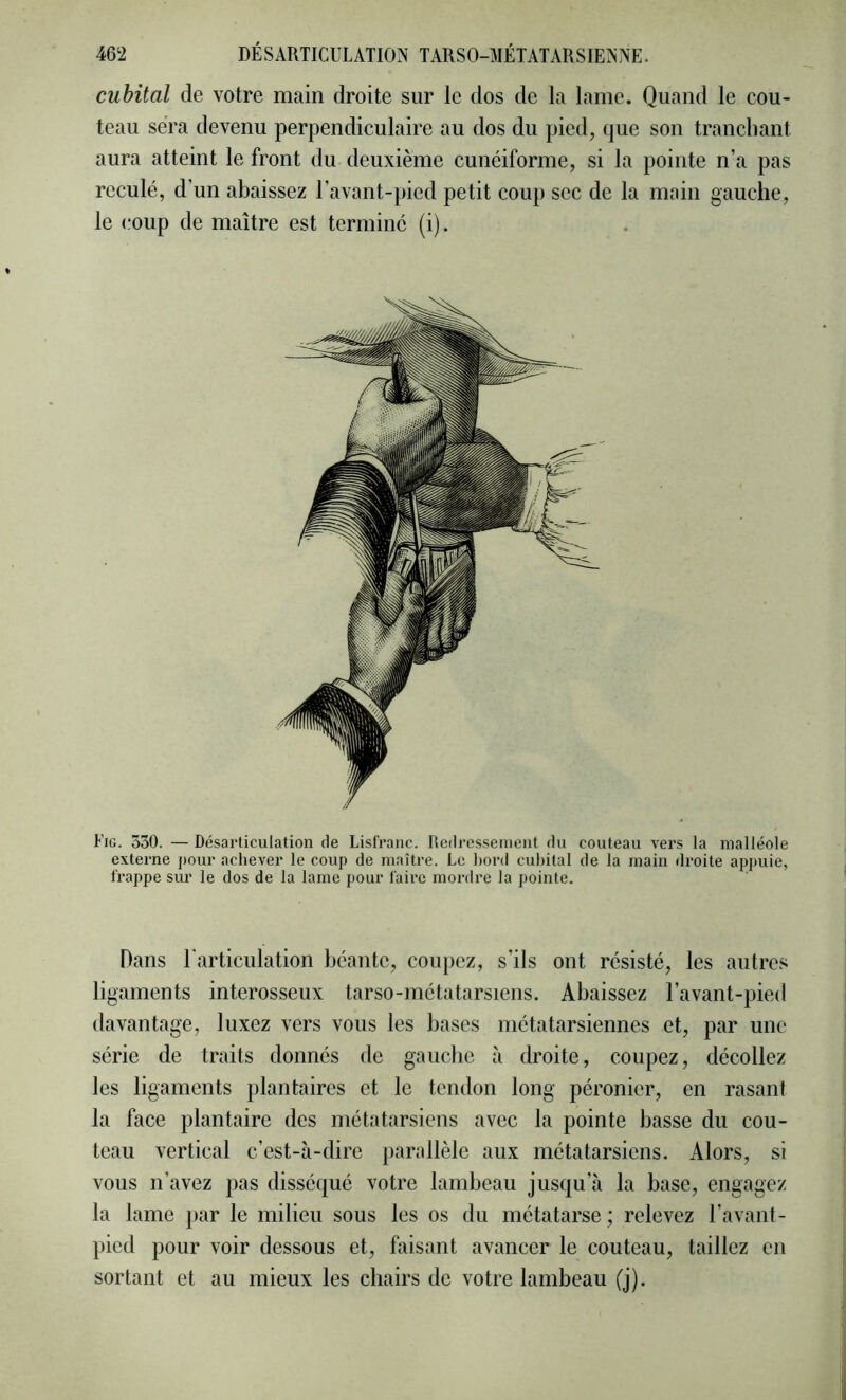 cubital de votre main droite sur le dos de la lame. Quand le cou- teau sera devenu perpendiculaire au dos du pied, que son tranchant aura atteint le front du deuxième cunéiforme, si la pointe n’a pas reculé, d’un abaissez l’avant-pied petit coup sec de la main gauche, le coup de maître est terminé (i). Fig. 330. — Désarticulation fie Lisfranc. Redressement du couteau vers la malléole externe pour achever le coup de maître. Le bord cubital de la main droite appuie, frappe sur le dos de la lame pour faire mordre la pointe. Dans l’articulation béante, coupez, s’ils ont résisté, les autres ligaments interosseux tarso-métatarsiens. Abaissez l’avant-pied davantage, luxez vers vous les bases métatarsiennes et, par une série de traits donnés de gauche à droite, coupez, décollez les ligaments plantaires et le tendon long péronier, en rasant la face plantaire des métatarsiens avec la pointe basse du cou- teau vertical c’est-à-dire parallèle aux métatarsiens. Alors, si vous n’avez pas disséqué votre lambeau jusqu’à la base, engagez la lame par le milieu sous les os du métatarse ; relevez l’avant- pied pour voir dessous et, faisant avancer le couteau, taillez en sortant et au mieux les chairs de votre lambeau (j).