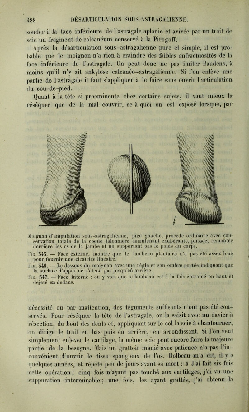 soucier à la face inférieure de l’astragale aplanie et avivée par un trait de scie un fragment de calcanéum conservé à la Pirogoff. Après la désarticulation sous-astragalienne pure et simple, il est pro- bable que le moignon n’a rien à craindre des faibles anfractuosités de la face inférieure de l’astragale. On peut donc ne pas imiter Baiidens, à moins qu’il n’y ait ankylosé calcanéo-astragalioime. Si l’on enlève une ])artie de l’astragale il faut s’appliquer à le faire sans ouvrir l’articulatioii du cou-de-pied. Quant à la tête si proéminente chez certains sujets, il vaut mieux la réséquer que de la mal couvrir, ce à quoi on est exposé lorsque, par .Moignon d’amputation .sous-astragalienne, pied gaucho, pi-océdé ordinaire avec con- servation totale de la coque talonnière maintenant exubérante, plissée, remontée derrière les os de la jambe et ne supportant pas le j)oids du corps. Fio. 345. — Face externe, montre que le lambeau plantaire n’a pas été assez long pour fournir une cicatrice linéaire. Fir.. 346. — Le dessous du moignon avec une règle et son ombre portée indiquant que la surface d’appui ne s’étend pas jusqu’en arrière. Fifi. 347. — Face interne ; on y voit que le lambeau est à la fois entraîné en haut et déjeté en dedans. nécessité ou par inattentiou, des tégumeuls suffisants n’ont pas été con- servés. Pour réséquer la tète de l’astragale, on la saisit avec un davier à résection, du bout des dents et, appliquant sur le col la scie à chantourner, on dirige le trait en bas puis en arrière, en arrondissant. Si l’on veut simplement enlever le cartilage, la même scie peut encore faire la majeure partie de la besogne. Mais un grattoir manié avec patience n’a pas l’in- convénient d’ouvrir le tissu spongieux de l’os. Dolbeau m’a dit, il y a quelques années, et répété peu de jours avant sa mort : « J’ai fait six fois cette opération; cinq fois n’ayant pas touché aux cartilages, j’ai vu une .suppuration interminable ; une fois, les ayant grattés, j’ai obtenu la