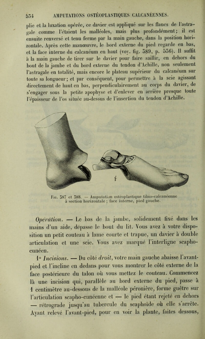 plie et la luxation opérée, ce davier est appliqué sur les flancs de l’astra- gale comme l’étaient les malléoles, mais plus profondément; il est ensuite renversé et tenu ferme par la main gauche, dans la position hori- zontale. Après cette manœuvre, le hord externe du pied regarde en has, et la face interne du calcanéum en haut (voy. fig. 589, p. 556). Il suffit à la main gauche de tirer sur le davier pour faire saillir, en dehors du bout de la jambe et du bord externe du tendon d’Achille, non seulement l’astragale en totalité, mais encore le plateau supérieur du calcanéum sur toute sa longueur ; et par conséquent, pour permettre à la scie agissant directement de haut en bas, perpendiculairement au corps du davier, de s’engager sous la petite apophyse et d’enlever en arrière presque toute l’épaisseur de l’os située au-dessus de l’insertion du tendon d’Achille. Fig. o87 et 588. — Amputation ostéoplastique libio-calcanéemie à section horizontale ; l'ace interne, pied gauche. Opération. — Le bas de la jambe, solidement fixé dans les mains d’un aide, dépasse le bout du lit. \ous avez à votre dispo- sition un petit couteau à lame courte et trapue, un davier à double articulation et une scie. Vous avez marqué l’interligne scapho- cunéen. 1» Incisions. — Du coté droit, votre main gauche abaisse l’avant- pied et l’incline en dedans pour vous montrer le côté externe de la face postérieure du talon où vous mettez le couteau. Commencez là une incision qui, parallèle au bord externe du pied, passe à 1 centimètre au-dessous de la malléole péronière, forme guêtre sur l’articulation scapbo-cunéenne et — le pied étant rejeté en dehors — rétrograde jusqu’au tubercule du scaphoïde où elle s’arrête. Ayant relevé l’avant-pied, pour en voir la plante, faites dessous,