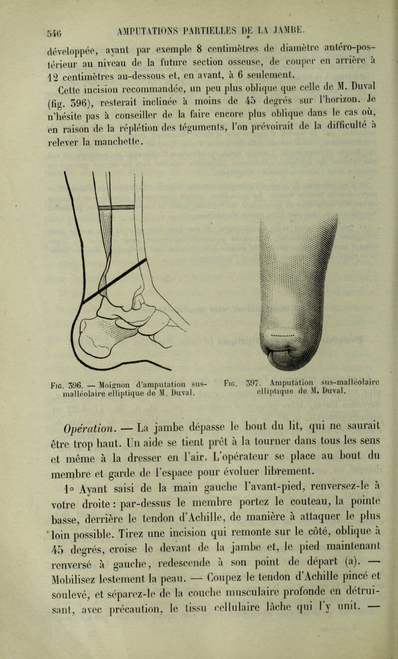 l 540 AMPUTATIONS PARTIELLES DE LA JAMRE. développée, ayant par exemple 8 centimètres de diamètre antéro-pos- térieur au niveau de la future section osseuse, de couper en arrière à 12 centimètres au-dessous et, en avant, à 6 seulement. Cette incision recommandée, un peu plus oblique que celle de M. Duval (fig. 596), resterait inclinée à moins de 45 degrés sur l’horizon. Je n’hésite pas à conseiller de la faire encore plus oblique dans le cas où, en raison de la réplétion des téguments, l’on prévoirait de la difficulté h relever la manchette. Fig. 396. — Moignon d’amputation sus- malléolaire elliptique de M. Duval. Fig. 397. Amputation sus-malléolaire elliptique de M, Duval. Opéfütiou. — La jambe dépasse le bout du lit, qui ne sauiait être trop haut. Un aide se tient prêt à la tourner dans tous les sens et même à la dresser en 1 air. L’opérateur se place au bout du membre et garde de l’espace pour évoluer librement. \o Ayant saisi de la main gauche l’avant-pied, renversez-le a votre droite : par-dessus le membre portez le couteau, la pointe basse, derrière le tendon d’Achille, de manière à attaquer le plus ‘loin possible. Tirez une incision qui remonte sur le côté, oblique à 45 degrés, croise le devant de la jambe et, le pied, maintenant, renversé à gauche, redescende à son point de départ (a). — Mobilisez lestement la peau. — Coupez le tendon d’Achille pincé et soulevé, et séparez-le de la couche musculaire profonde en détrui- sant, avec précaution, le tissu cellulaire lâche qui ly unit.