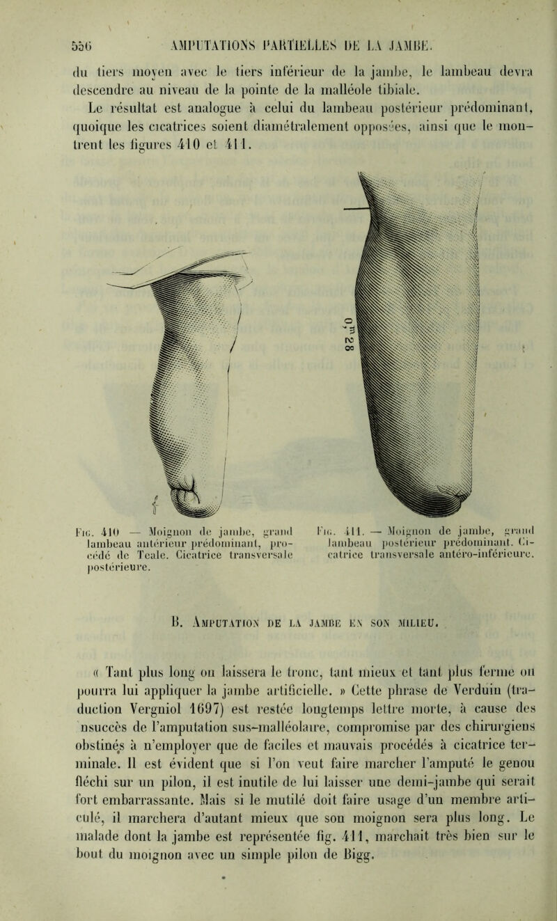 (lu tiers moyeu avec le tiers iulerieur de la jambe, le lambeau devra descendre au niveau de la pointe de la malléole tibiale. Le résultat est analogue à celui du lambeau postérieur prédominanl, quoique les cicatrices soient diamétralement opposées, ainsi que le mon- trent les ligures -410 et 411. Fk;. 410 — Moignon do jaml)C, grand lambeau antérieur ])rédoininanl, pro- et'dc de Tealc. Cicatrice transversale postiirieure. Fie. ill. — Moignon de jandjc, grand lambeau postérieur prédominant, (n- catrice transversale antéro-inférieure. 11. AMPL’T.VTtON DE L.V J.VMBE EN SON MtLIEU. « Tant plus long ou laissera le tronc, tant mieux et tant plus lérme on pourra lui appliquer la jambe artificielle. » Cette phrase de Verduiu (tra- duction Vergniol 1697) est restée longtemps lettre morte, à cause des nsucccs de l’amputation sus-rnalléolaire, compromise par des chirurgiens obstinés à n’employer que de faciles et mauvais procédés à cicatrice ter- minale. Il est évident que si l’on veut faire marcher l’amputé le genou fléchi sur un pilon, il est inutile de lui laisser une demi-jambe qui serait fort embarrassante. ?4ais si le mutilé doit faire usage d’un membre arti- culé, il marchera d’autant mieux que son moignon sera plus long. Le malade dont la jambe est représentée fig. 411, marchait très bien sur le bout du moignon avec un simple pilon de Bigg.