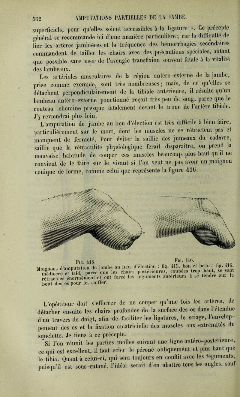 superficiels, pour qu’elles soient accessibles à la ligature )). Ce précepte général se recommande ici d’une manière particulière ; car la difficulté de lier les artères jambières et la fréquence des hémorrhagies secondaires commandent de tailler les chairs avec des précautions spéciales, autant que possible sans user de l’aveugle transfixion souvent fatale à la vitalité des lambeaux. Les artérioles musculaires de la région antéro-externe de la jambe, prise comme exemple, sont très nombreuses; mais, de ce qu’elles se détachent perpendiculairement de la tibiale antérieure, il résulte qu un lambeau antéro-externe ponctionné reçoit très peu de sang, parce que le couteau chemine presque fatalement devant le tronc de 1 artère tibiale. J’y reviendrai plus loin. L’amputation de jambe au lieu d’élection est très difficile à bien faire, particulièrement sur le mort, dont les muscles ne se rétractent pas et manquent de fermeté. Pour éviter la saillie des jumeaux du cadavre, saillie que la rétractilité physiologique ferait disparaître, on prend la mauvaise habitude de couper ces muscles beaucoup plus haut qu’il ne convient de le faire sur le vivant si l’on veut ne pas avoir un moignon conique de forme, comme celui que représente la figure 416. Fig. 415. Fig. 416. Moi-nons d’amputation de jambe au lieu d’élection : fig. 415, bon et beau ; fig. 416, m'ediocre et laid, parce que les chairs postérieures, coupees trop haut, se sont rétractées énormément et ont forcé les téguments anterieurs a se tendre sur le bout des os pour les coiffer. L’opérateur doit s’efforcer de ne couper qu’une fois les artères, de détacher ensuite les chairs profondes de la surface des os dans l’etendue d’un travers de doigt, afin de faciliter les ligatures, le sciage, l’envelop- pement des os et la fixation cicatricielle des muscles aux extrémités du squelette. Je tiens à ce précepte. Si l’on réunit les parties molles suivant une ligne antéro-postérieure, ce qui est excellent, il faut scier le péroné obliquement et plus haut que le tibia. Quant à celui-ci, qui sera toujours en conflit avec les téguments, puisqu’il est sous-cutané, l’idéal serait d’en abattre tous les angles, sauf