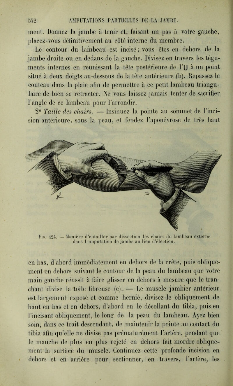 ment. Donnez la jambe à tenir et, faisant un pas à votre gauche, placez-vous definitivement au côté interne du membre. Le contour du lambeau est incisé ; vous ôtes en dehors de la jambe droite ou en dedans de la gauche. Divisez en travers les tégu- ments internes en réunissant la tête postérieure de l’U un point situé à deux doigts au-dessous de la tête antérieure (b). Repassez le couteau dans la plaie afin de permettre à ce petit lambeau triangu- laire de bien se rétracter. Ne vous laissez jamais tenter de sacrifier l’angle de ce lambeau pour l’arrondir. 2 Taille des chairs. — Insinuez la pointe au sommet de l’inci- sion antérieure, sous la peau, et fendez l’aponévrose de très haut Fig. 424. — Manière (l’entailler par dissection les chairs du lamhcau externe dans l’amputation de jainhe au lien d’élection. en bas, d’abord immédiatement en dehors de la crête, puis obli([iic- ment en dehors suivant le contour de la peau du lambeau que votre main gauche réussit à faire glisser en dehors à mesure que le tran- chant divise la toile fibreuse (c). — Le muscle jambier antérieur est largement exposé et comme hernié, divisez-le obliquement de haut en bas et en dehors, d’abord en le décollant du tibia, puis en l’incisant obliquement, le long de la peau du lambeau. Ayez bien soin, dans ce trait descendant, de maintenir la pointe au contact du tibia afin qu’elle ne divise pas prématurément l’artère, pendant que le manche de plus en plus rejeté en dehors fait mordre oblique- ment la surface du muscle. Continuez cette profonde incision en dehors et en arrière pour sectionner, en travers, l’artère, les