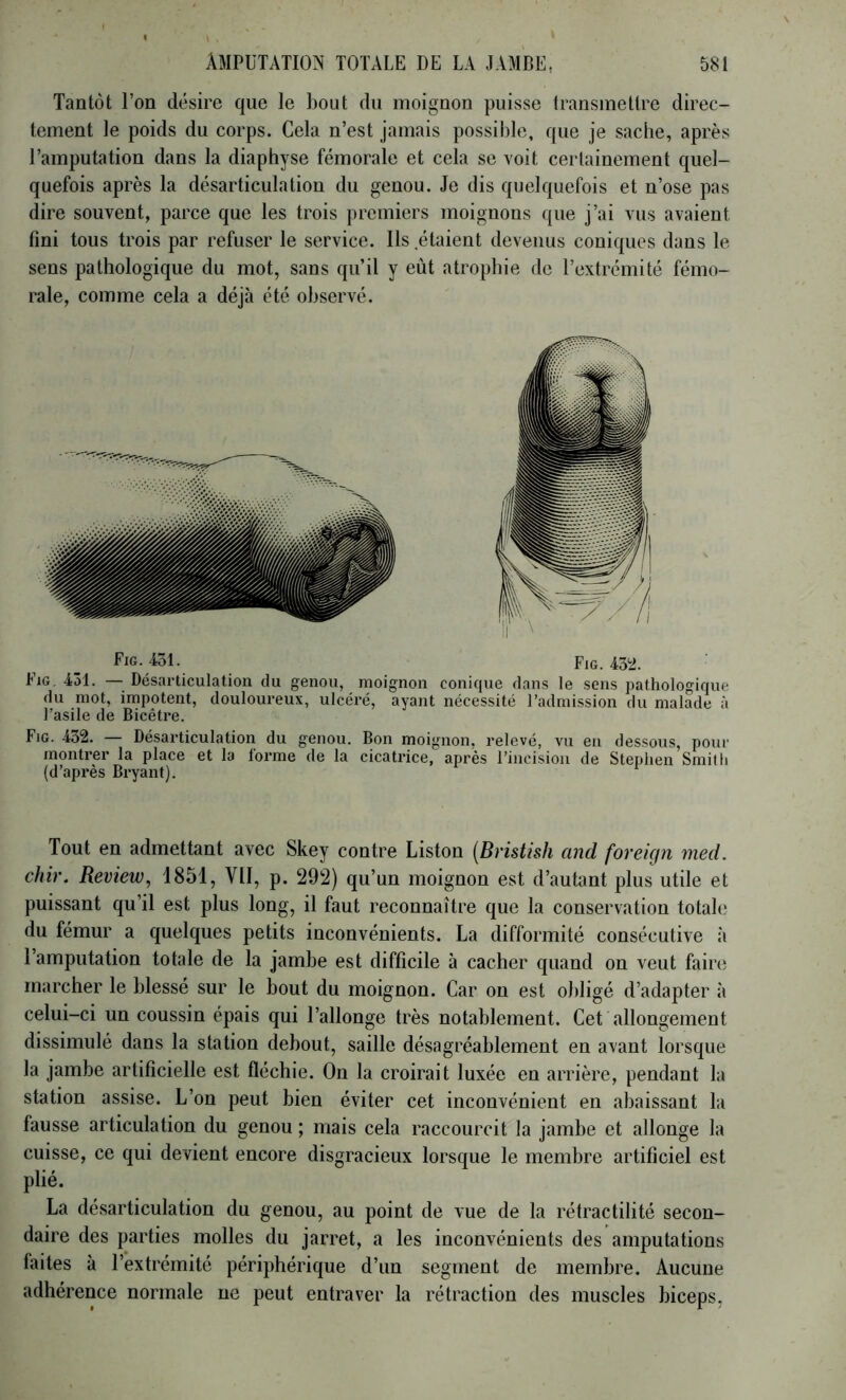 Tantôt l’on désire que le bout du moignon puisse transmettre direc- tement le poids du corps. Cela n’est jamais possible, que je sache, après l’amputation dans la diaphyse fémorale et cela se voit certainement quel- quefois après la désarticulation du genou. Je dis quelquefois et n’ose pas dire souvent, parce que les trois premiers moignons que j’ai vus avaient fini tous trois par refuser le service. Ils étaient devenus coniques dans le sens pathologique du mot, sans qu’il y eut atrophie de l’extrémité fémo- rale, comme cela a déjà été observé. Fig. 431. Fig. 432. Fig. 431. — Désarticulation du genou, moignon conique dans le sens pathologique du mot, impotent, douloureux, ulcéré, ayant nécessité l’admission du malade à l’asile de Bicêtre. Fig. 432. — Désarticulation du genou. Bon moignon, relevé, vu en dessous, pour montrer la place et la forme de la cicatrice, après l’incision de Stephen Smilli (d’après Bryant). Tout en admettant avec Skey contre Liston [Bristish and foveign nied. chir. Review, 1851, VU, p. 292) qu’un moignon est d’autant plus utile et puissant qu’il est plus long, il faut reconnaître que la conservation totale du fémur a quelques petits inconvénients. La difformité consécutive à 1 amputation totale de la jambe est difficile à cacher quand on veut faire marcher le blessé sur le bout du moignon. Car on est obligé d’adapter à celui-ci un coussin épais qui l’allonge très notablement. Cet allongement dissimulé dans la station debout, saille désagréablement en avant lorsque la jambe artificielle est fléchie. On la croirait luxée en arrière, pendant la station assise. L’on peut bien éviter cet inconvénient en abaissant la fausse articulation du genou ; mais cela raccourcit la jambe et allonge la cuisse, ce qui devient encore disgracieux lorsque le membre artificiel est plié. La désarticulation du genou, au point de vue de la rétractilité secon- daire des parties molles du jarret, a les inconvénients des amputations faites à l’extrémité périphérique d’un segment de membre. Aucune adhérence normale ne peut entraver la rétraction des muscles biceps,