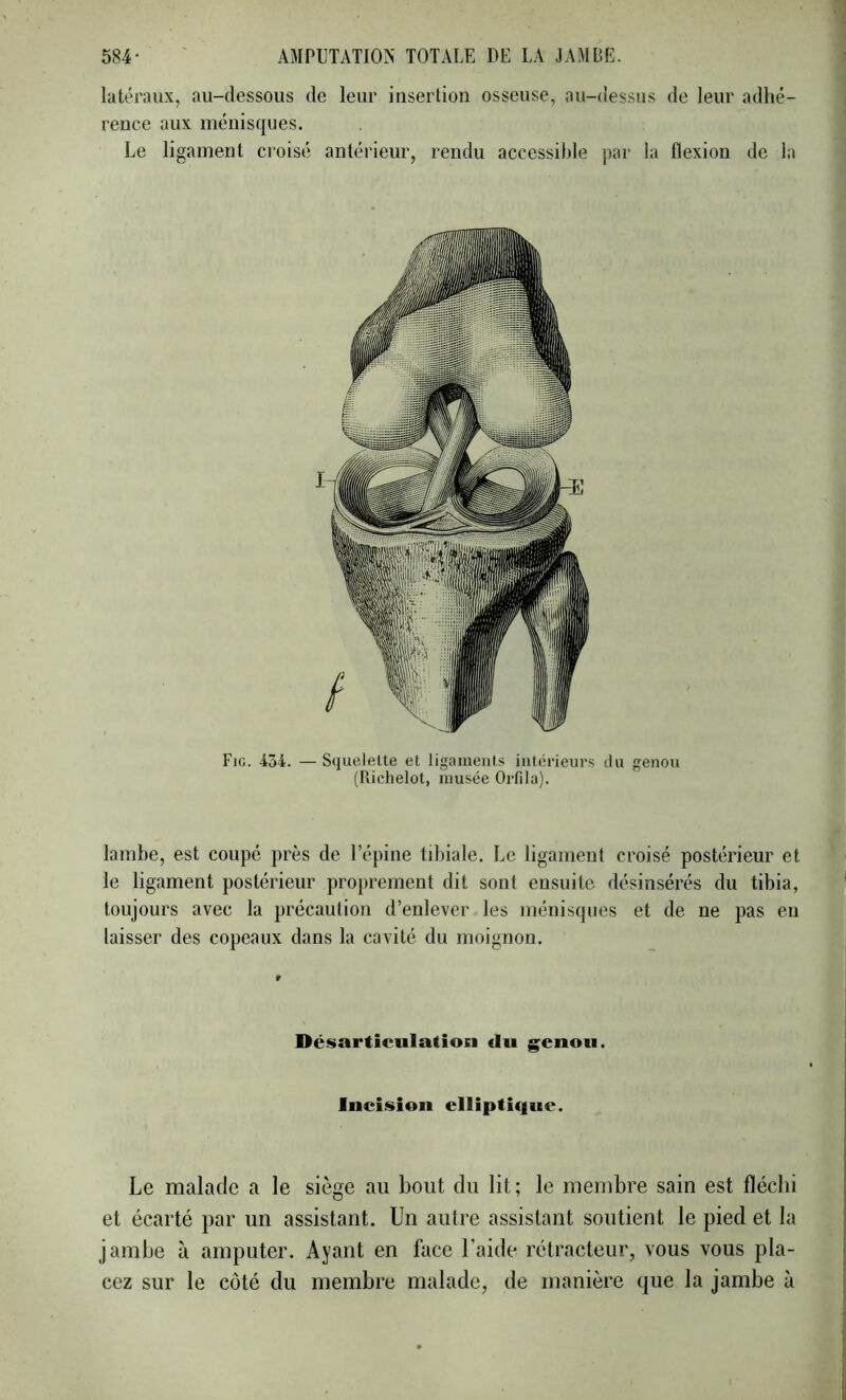 latéraux, au-dessous de leur insertion osseuse, au-dessus de leur adhé- rence aux ménisques. Le ligament croisé antérieur, rendu accessible par la flexion de la Fie. 434. — Squelette et ligaments intérieurs du genou (Richelot, musée Orfila). Ïambe, est coupé près de l’épine tibiale. Le ligament croisé postérieur et le ligament postérieur proprement dit sont ensuite désinsérés du tibia, toujours avec la précaution d’enlever les ménisques et de ne pas en laisser des copeaux dans la cavité du moignon. Désarticulation du genou. Incision elliptique. Le malade a le siège au bout du lit; le membre sain est fléchi et écarté par un assistant. Un autre assistant soutient le pied et la jambe à amputer. Ayant en face l’aide rétracteur, vous vous pla- cez sur le côté du membre malade, de manière que la jambe à