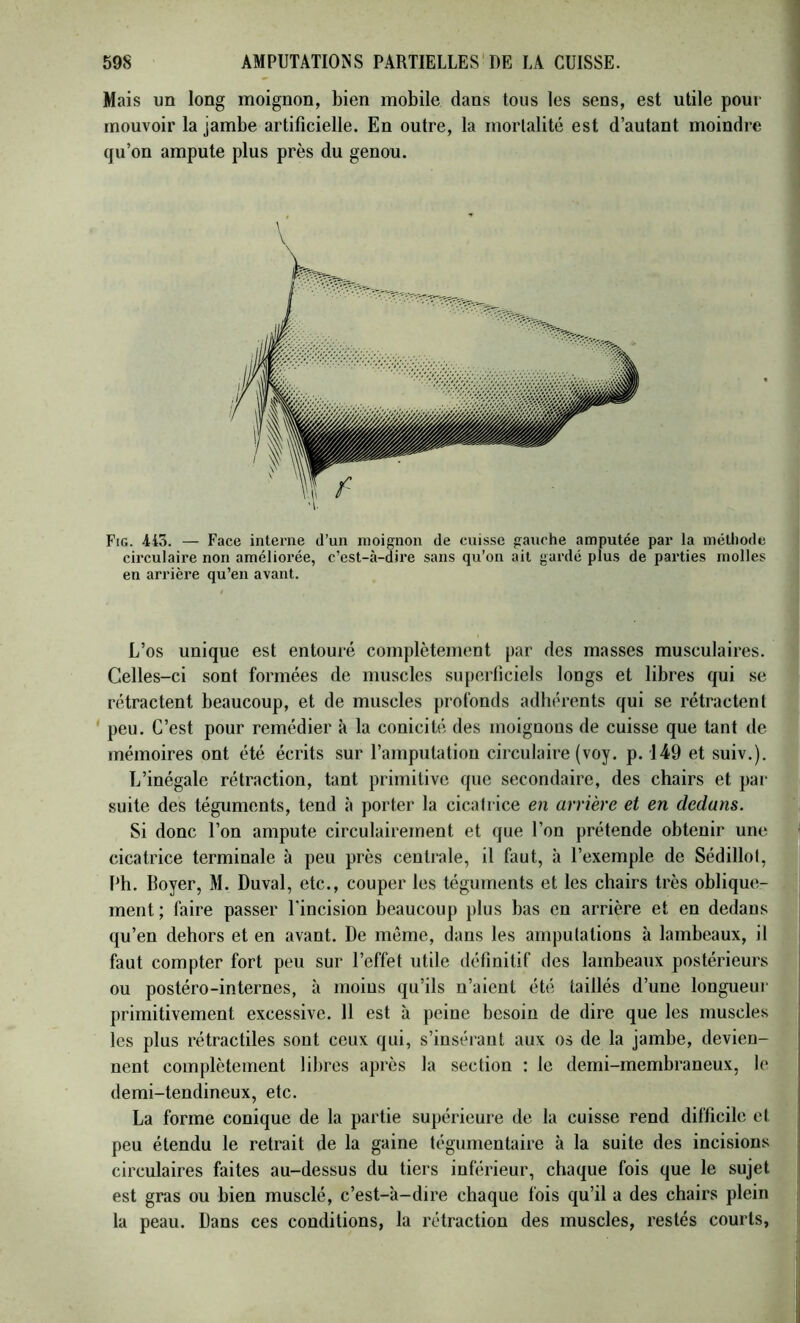 Mais un long moignon, bien mobile dans tous les sens, est utile pour mouvoir la jambe artificielle. En outre, la mortalité est d’autant moindre qu’on ampute plus près du genou. Fig. 4io. — Face interne d’un moignon de cuis.se gauche amputée par la méthode circulaire non améliorée, c’est-à-dire sans qu’on ait gardé plus de parties molles en arrière qu’en avant. L’os unique est entouré complètement par des masses musculaires. Celles-ci sont formées de muscles superficiels longs et libres qui se rétractent beaucoup, et de muscles profonds adhérents qui se rétractent ' peu. C’est pour remédier à la conicité des moignons de cuisse que tant de mémoires ont été écrits sur l’amputation circulaire (voy. p. 149 et suiv.). L’inégale rétraction, tant primitive que secondaire, des chairs et par suite des téguments, tend à porter la cicalrice en arrière et en dedans. Si donc l’on ampute circulairernent et que l’on prétende obtenir une cicatrice terminale à peu près centrale, il faut, à l’exemple de Sédillot, Ph. Boyer, M. Duval, etc., couper les téguments et les chairs très oblique- i ment; faire passer l'incision beaucoup plus bas en arrière et en dedans qu’en dehors et en avant. De même, dans les amputations à lambeaux, il faut compter fort peu sur l’effet utile définitif des lambeaux postérieurs ou postéro-internes, à moins qu’ils n’aient été taillés d’une longueur primitivement excessive. 11 est à peine besoin de dire que les muscles les plus rétractiles sont ceux qui, s’insérant aux os de la jambe, devien- nent complètement libres après la section : le demi-membraneux, le demi-tendineux, etc. La forme conique de la partie supérieure de la cuisse rend difficile et peu étendu le retrait de la gaine tégumentaire à la suite des incisions circulaires faites au-dessus du tiers inférieur, chaque fois que le sujet est gras ou bien musclé, c’est-à-dire chaque fois qu’il a des chairs plein ,! la peau. Dans ces conditions, la rétraction des muscles, restés courts,