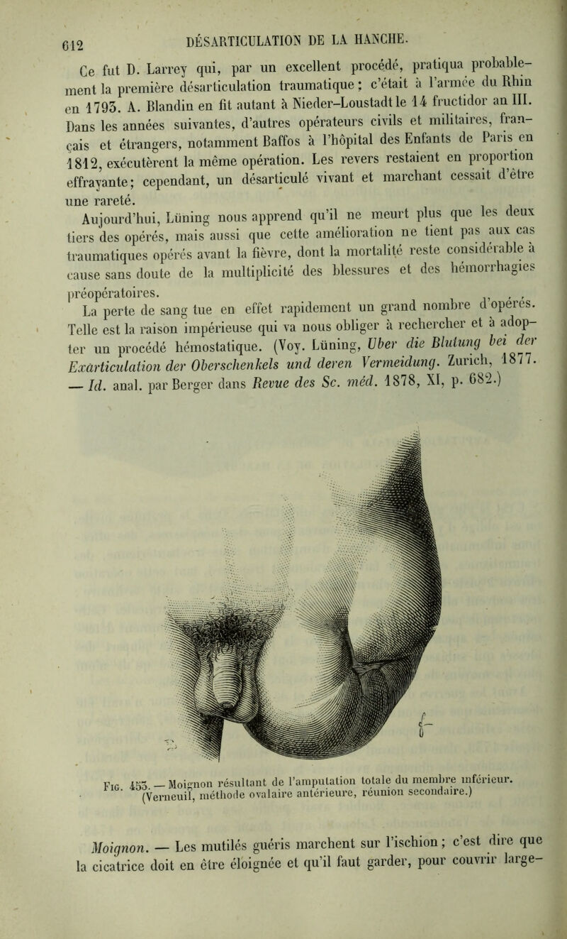 Ce fut D. Larrey qui, par un excellent procédé, pratiqua probable- ment la première désarticulation traumatique ; c’était à l’armée du Rhin en 1793. A. Blandin en fit autant à Nieder-Loustadt le 14 fructidor an III. Dans les années suivantes, d’autres opérateurs civils et militaires, fian- çais et étrangers, notamment Baffos à l’hôpital des Enfants de Paris en 1812, exécutèrent la même opération. Les revers restaient en proportion effrayante; cependant, un désarticulé vivant et marchant cessait d être une rareté. Aujourd’hui, Lüning nous apprend qu’il ne meurt plus que les deux tiers des opérés, mais aussi que cette amélioration ne tient pas aux cas traumatiques opérés avant la fièvre, dont la mortalité reste considéiahle à cause sans doute de la multiplicité des blessures et des hémorrhagies préopératoires. La perte de sang tue en effet rapidement un grand nombre d opérés. Telle est la raison impérieuse qui va nous obliger à rechercher et à adop- ter un procédé hémostatique. (Voy. Lüning, Uber die Bluiung hei de) Exürticulation der Oberschenkels und deren Vermeidung. Zurich, 1877. — Id. anal, par Berger dans Revue des Sc. méd. 1878, XI, p. 682.) P,P iK’x _ Moignon résultant de l’amputation totale du membre inférieur. (Verneuiî, méthode ovalaire antérieure, réunion secondaire.) Moignon. — Les mutilés guéris marchent sur l’ischion ; c’est dire que la cicatrice doit en être éloignée et qu’il faut garder, pour couvrir large-