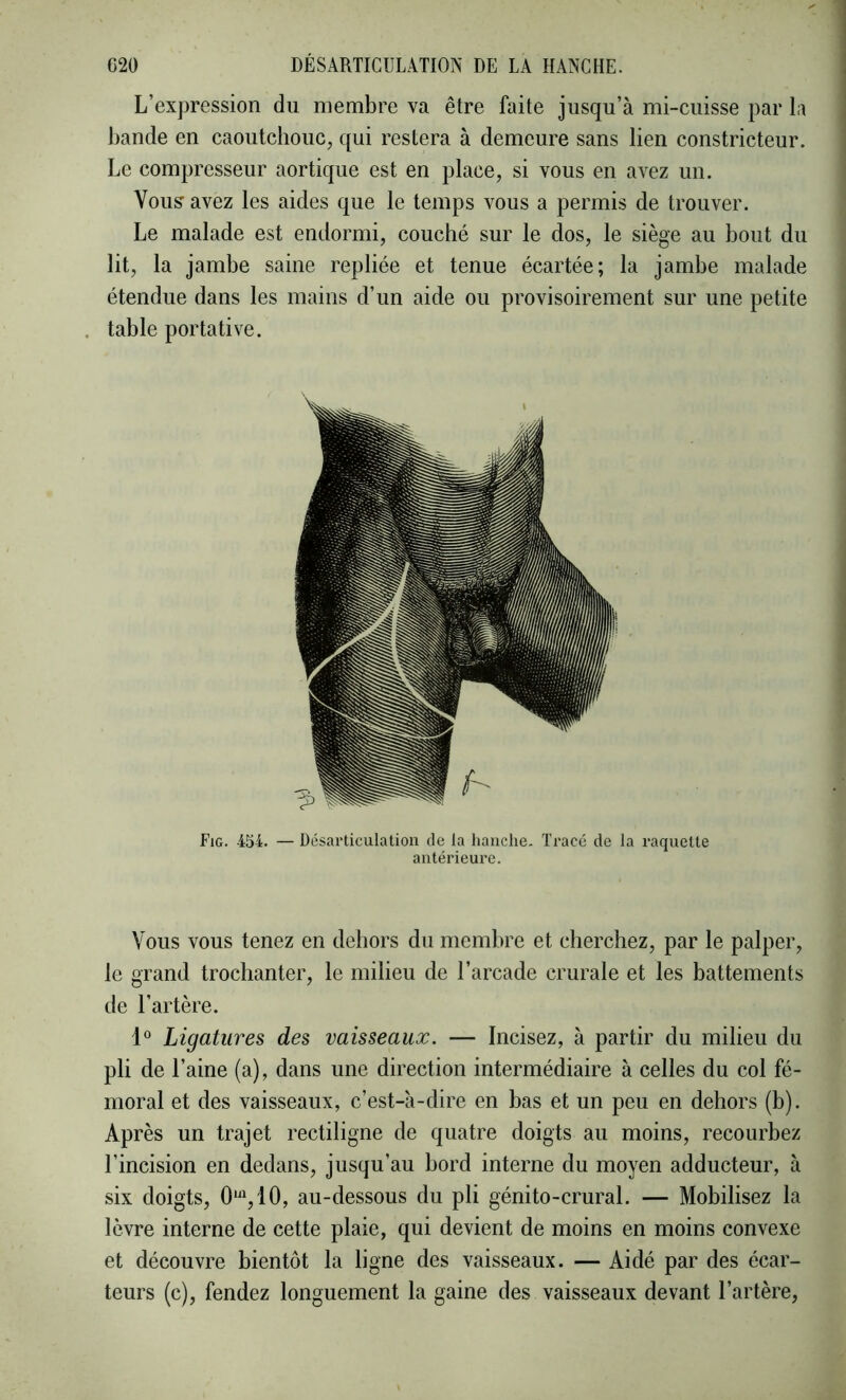 L’expression du membre va être faite jusqu’à mi-cuisse par h bande en caoutchouc, qui restera à demeure sans lien constricteur. Le compresseur aortique est en place, si vous en avez un. Vous’ avez les aides que le temps vous a permis de trouver. Le malade est endormi, couché sur le dos, le siège au bout du lit, la jambe saine repliée et tenue écartée; la jambe malade étendue dans les mains d’un aide ou provisoirement sur une petite . table portative. Fig. 4SI. — Désarticulation de la hanche. Tracé de la raquette antérieure. Vous VOUS tenez en dehors du membre et cherchez, par le palper, le grand trochanter, le milieu de l’arcade crurale et les battements de l’artère. 1 Ligatures des vaisseaux. — Incisez, à partir du milieu du pli de l’aine (a), dans une direction intermédiaire à celles du col fé- moral et des vaisseaux, c’est-à-dire en bas et un peu en dehors (b). Après un trajet rectiligne de quatre doigts au moins, recourbez l’incision en dedans, jusqu’au bord interne du moyen adducteur, à six doigts, O'^qlO, au-dessous du pli génito-crural. — Mobilisez la lèvre interne de cette plaie, qui devient de moins en moins convexe et découvre bientôt la ligne des vaisseaux. — Aidé par des écar- teurs (c), fendez longuement la gaine des vaisseaux devant l’artère,