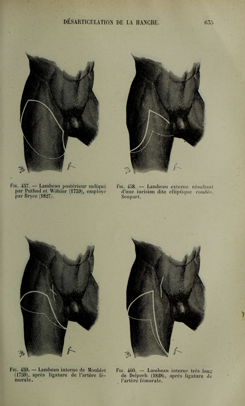 \ Fig. 457. — Lambeau postérieur indiqué par Puthod et Wôhler (1739), employé par Bryce (1827). Fig. 459. — Lambeau interne de Moublet (1759), après ligature de l’artère fé- morale. Fig. 458. — Lambeau externe résull.-nil d’une incision dite elliptique coudéi% Soupart. Fig, 460. — Lambeau interne très long de Delpech (1828), après ligature de ^ l’artère fémorale.