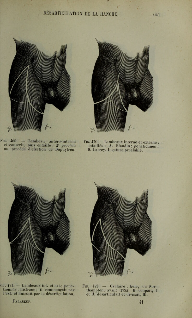 DÉSAliTiaLATlUM DK LA IIAN'CMK. Fig. 4G9. ■— Lambeau anléro-interuc cii'couscrif., puis entaillé ; 2“ procédé ou jtrocédé d’élection de Dupuytreu. Fig. 470. — Lambeaux interne et externe ; entaillés ; A. Blandin; ponctionnés ; D. Larrey. Li{,uUure préalable. Î^IG. 471. — Lambeaux inl. et ext.; j»onc- tionnés : Lislranc ; il commençait par Fext. et linissait par la désarticulation. Faracei.’f. Fig. 472. — Ovalaire : Kerr, de Nor- tbampton, avant 179o. 11 coupait, I et 11, désarticulait et divisait, 111. 41