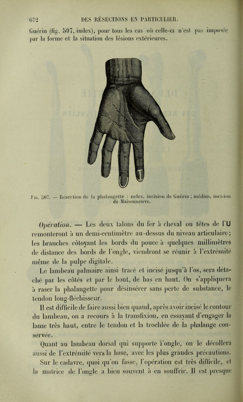 Guériu (fig. 507, index), pour tous les eus où celle-ci ii’esl pas imposée par la l'orme et la situation des lésions extérieures. Ek;. 5Ü7. — Uésec'Uou de la plialaugeUe : index, iucisioii du Guérin ; médius, iuci.ùoii de Maisonneuve. Opération. — Les deux talons du fer à cheval ou têtes de LU remonteront à un demi-centimètre au-dessus du niveau articulaire; les branches côtoyant les bords du pouce à quelques millimètres de distance des bords de l’ongle, viendront se réunir à l’extrémité même de la pulpe digitale. Le lambeau palmaire ainsi Iracé et incisé jusqu’à Los, sera déta- ebé par les côtés et par le bout, de bas en haut. On s’appliquera à raser la phalangette jiour désinsérer sans jierte de substance, le tendon long-flécbisseur. Il est difficile de faire aussi bien quand, après avoir incisé le contour du lambeau, on a recours à la transfixion, en essayant d’engager la lame très haut, entre le tendon et la trocldée de la })balange con- servée. Quant au lambeau dorsal qui supporte l’ongle, on le décollera aussi de rextrémité vers la base, avec les plus grandes précautions. Sur le cadavre, quoi ({u’oii fasse, l’opération est très difficile, cl