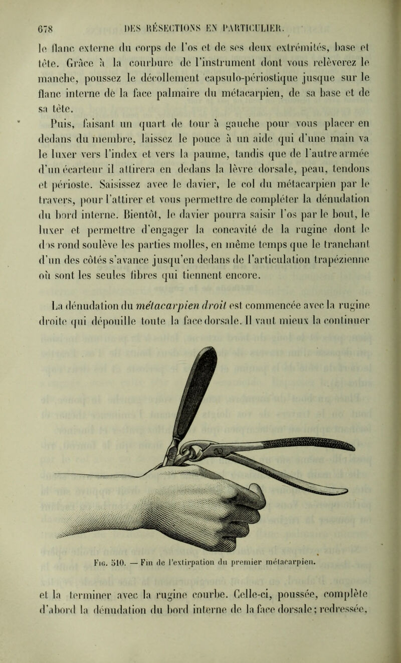 lo liane externe dn eorps de l’os et de ses deux extrémités, hase et tète. Grâce à la courhnrc de rinstrumont dont vous relèverez le manche, poussez le décollcmeut capsulo-périostique jusque sur le flanc interne de la face palmaire du métacarpien, de sa base et de sa tète. Puis, faisant un quart de tour à gauche pour vous placer eu dedans du membre, laissez le ])ouce à un aide qui d’une main va le luxer vers l’index et vers la paume, taudis que de Paiitre armée d’un écarteur il attirera eu dedans la lèvre dorsale, peau, tendons et péiioste. Saisissez avec le davier, le col du métacarpien par le travers, pour l’attirer et vous permettre de compléter la dénudation du bord interne. Bientôt, le davier pourra saisir l’os parle bout, le luxer et permettre d’engager la concavité de la rugine dont le d )s rond soulève les parties molles, en même temps que le trancliant d’un des côtés s’avance jusqu’en dedans do l’articulation trapézienne où sont les seules libres qui tiennent encoi’e. La dénudation du métacarpien droit est commencée avec la rugine di'oite qui dépouille toute la facedorsale.il vaut mieux la continuer et la terminer avec la rugine courbe. Celle-ci, poussée, comj)lète d’abord la dénudation du bord interne de la face dorsale ; redressée.