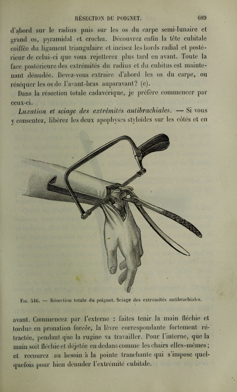 d’abord sur le radius puis sur les os du earpe senii-luiiaire et grand os, pyramidal et crochu. Découvrez entin la tête cubitale coiflce du ligament triangulaire et incisez les bords radial et posté- rieur de celui-ci que vous rejetterez plus tard en avant. Toute la lace postérieure des extrémités du radius et du cubitus est mainte- nant dénudée. Devez-vous extraire d’abord les os du carpe, ou réséquer les os de l’avant-bras auparavant? (c). Dans la résection totale cadavérique, je préfère commencer par ceux-ci. Luxation et sciage des extrémités antibrachiales. — Si vous y consentez, libérez les deux apophyses styloïdes sur les côtés et en Fig. 516. — Ucsecliou totale du poignet. Sciage des extrémités aiitibrachialcs. avant. Commencez par l’externe : faites tenir la main fléchie et tordue en pronation forcée, la lèvre correspondante fortement ré- tractée, ])endant que la rugine va travailler. Pour l’interne, que la main soit fléchie et déjetée en dedans comme les chairs elles-mêmes; et recourez au besoin a la pointe tranchante qui s’impose (|uel- quefois pour bien dénuder l’extrémité cubitale.