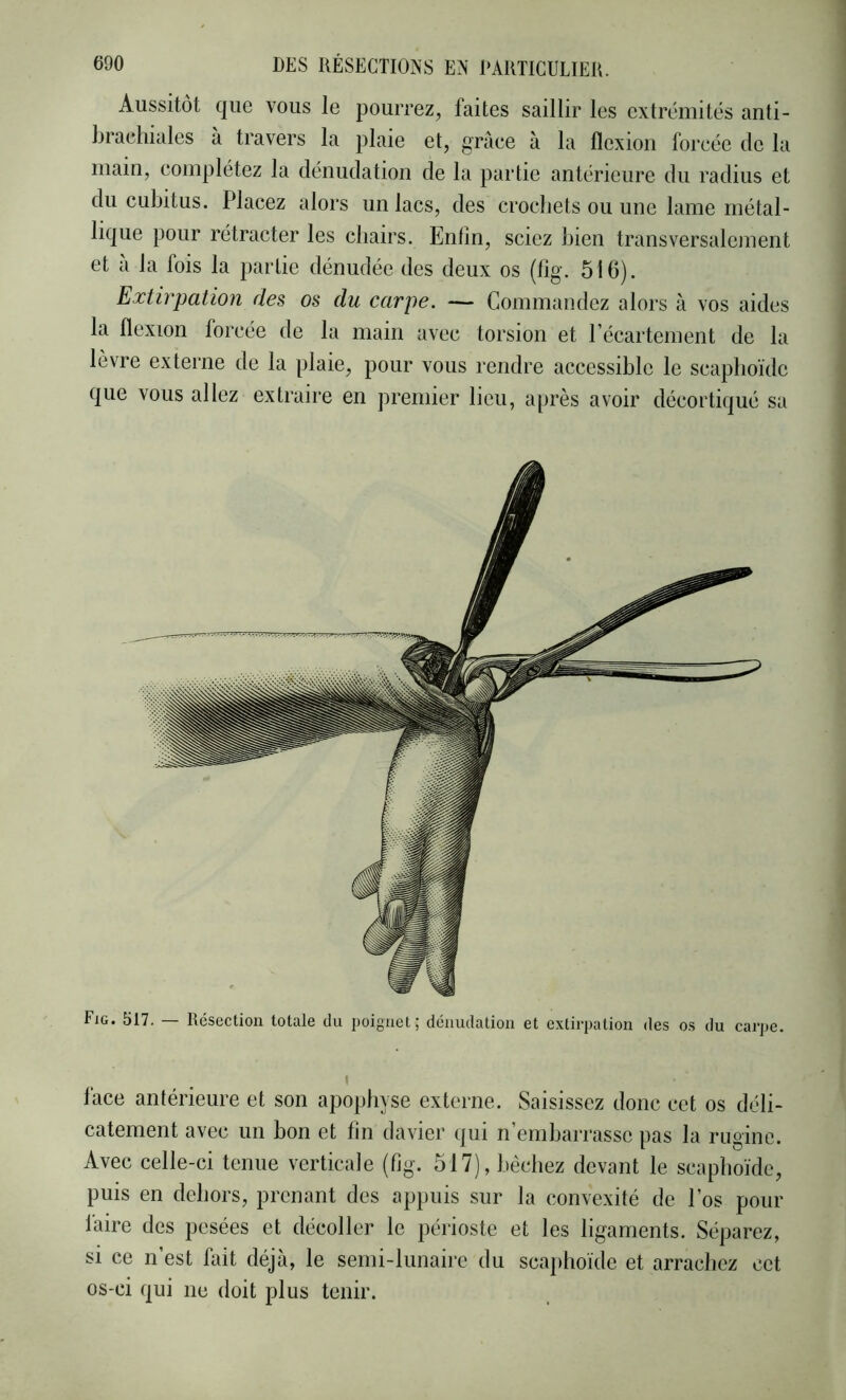 Aussitôt que vous le pourrez, faites saillir les extrémités anti- brachiales à travers la plaie et, grâce à la flexion forcée de la main, complétez la dénudation de la partie antérieure du radius et du cubitus. Placez alors un lacs, des crochets ou une lame métal- lique pour rétracter les chairs. Enfin, sciez bien transversalement et à la fois la partie dénudée des deux os (lig. 516). Extirpation des os du carpe. — Commandez alors à vos aides la flexion forcée de la main avec torsion et l’écartement de la lèvre externe de la plaie, pour vous rendre accessible le scaphoïde que vous allez extraire en premier lieu, après avoir décortiqué sa Fig. 517. — Résection totale du poignet; dénudation et extirpation des os du carpe. face antérieure et son apophyse externe. Saisissez donc cet os déli- catement avec un bon et fin davier qui n’embarrasse pas la rugine. Avec celle-ci tenue verticale (fig. 517), bêchez devant le scaphoïde, puis en dehors, prenant des appuis sur la convexité de l’os pour laire des pesées et décoller le périoste et les ligaments. Séparez, si ce n’est fait déjà, le semi-lunaire du scaphoïde et arrachez cet os-ci qui ne doit plus tenir.