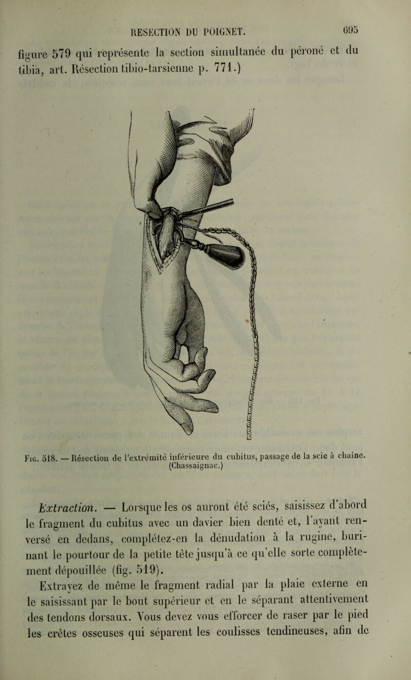 figure 579 qui représente la section simultanée du péroné et du tibia, art. Résection tibio-tarsienne p. 771.) Fin. 518. — Résection de l’extrémitc inférieure du cubitus, passage de la scie à chaîne. (Chassaignac.) Extraction. — Lorsque les os auront été sciés, saisissez d’abord le fragment du cubitus avec un davier bien denté et, l’ayant ren- versé en dedans, complétez-en la dénudation à la rugine, buri- nant le pourtour de la petite tête jusqu’à ce qu’elle sorte complète- ment dépouillée (lig. 519). Extrayez de même le fragment radial par la plaie externe en le saisissant par le bout supérieur et en le séparant attentivement des tendons dorsaux. Vous devez vous efforcer de raser par le pied les crêtes osseuses qui séparent les coulisses tendineuses, afin de