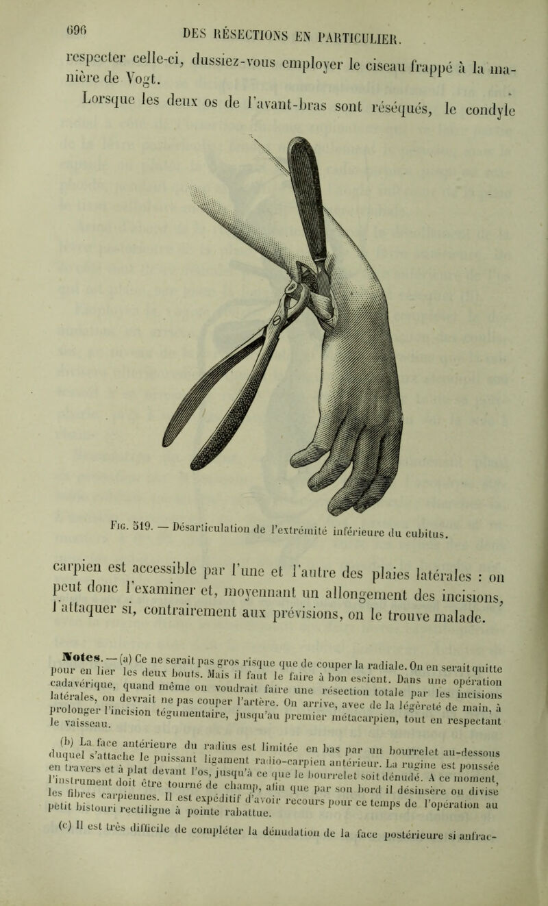 (ion rcs(jecter celle-ci, dussiez-vous employer le ciseau frappé à la ma- merede\ogt. Lorsque les deux os de l'avant-bras sont réséiiués, le condyle Fig. S19. — Désarîiculalioii de l’extrémité infér ieure du cubitus. carpieii est accessible par Time et l'antre des plaies latérales • on peut donc l'examiner et, moyennant nn allongement des incisions, 1 attaquer si, contrairement aux prévisions, on le trouve malade. Ou en serait quitte ^'rkl: l'instrument duil'ètr. i *^,'*'* *’ ® liouri-olet soit dénudé. .A ce moment les nin-es cnté niésb ëér r u'’’ '' ou divisj l'otit Wstoun'recUligno “lain™' (c) Il est très d.riicile ,1e co,u|,lélcr la déimclalton do la lace ,,oslé,-ieure siaulrac-