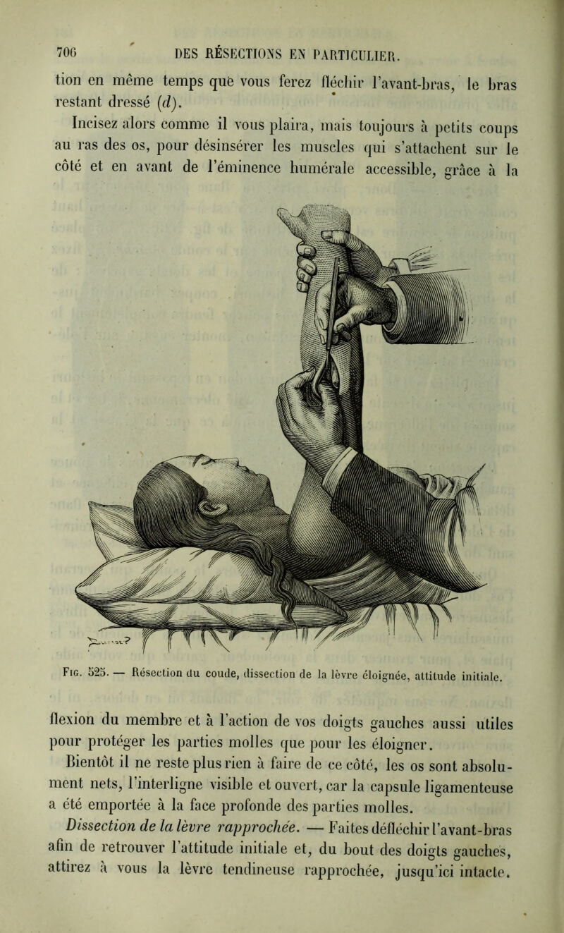 tion en même temps qufe vous ferez fléchir l’avant-bras, le bras restant dressé (d). Incisez alors comme il vous plaira, mais toujours à petits coups au ras des os, pour désinsérer les muscles qui s’attachent sur le côté et en avant de l’éminence humérale accessible, grâce à la flexion du membre et à l’action de vos doigts gauches aussi utiles pour protéger les parties molles que pour les éloigner. Bientôt il ne reste plus rien à faire de ce côté, les os sont absolu- ment nets, 1 interligne visible et ouvert, car la capsule ligamenteuse a été emportée à la face profonde des parties molles. Dissection de la lèvre rapprochée. — Faites défléchir l’avant-bras afin de retrouver l’attitude initiale et, du bout des doists sauches, • \ . DO* attirez a vous la lèvre tendineuse rapprochée, jusqu’ici intacte.