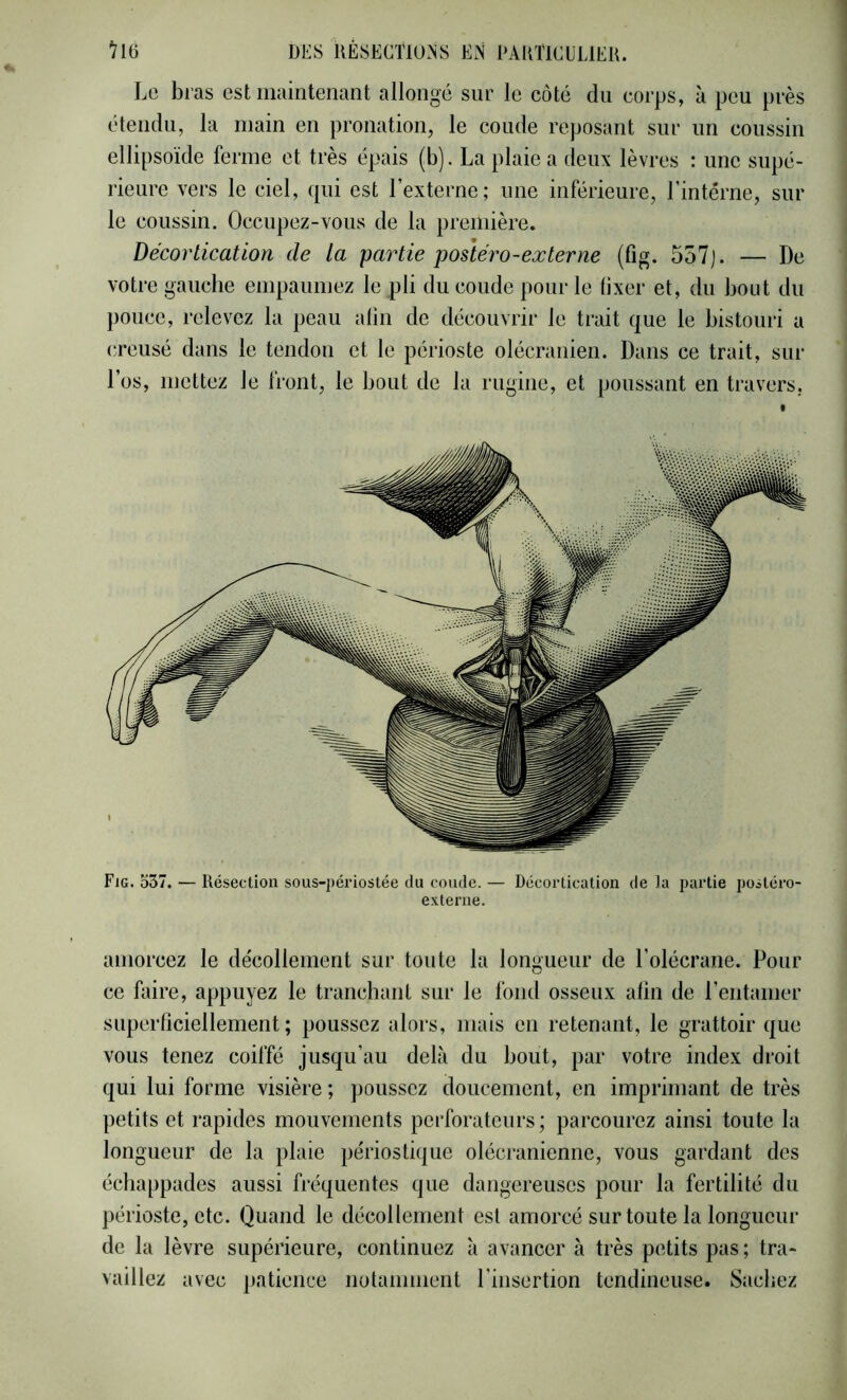 Le bras est maintenant allongé sur le côté du corps, à peu près étendu, la main en pronation, le coude reposant sur un coussin ellipsoïde ferme et très épais (b). La plaie a deux lèvres : une supé- rieure vers le ciel, qui est l’externe; une inférieure, l'intême, sur le coussin. Occupez-vous de la première. Décortication de la partie postéro-externe (fig. 557). — De votre gauche empaumez le pli du coude pour le lixer et, du bout du pouce, relevez la peau afin de découvrir le trait que le bistouri a creusé dans le tendon et le périoste olécranien. Dans ce trait, sur l’os, mettez le front, le bout de la rugine, et poussant en travers. Fig. o37. — Résection sous-j)ériostée du coude. — Décortication de )a partie postéro- externe. amorcez le de'collement sur toute la longueur de l’olécrane. Pour ce faire, appuyez le tranchant sur le fond osseux afin de l’entamer superficiellement; poussez alors, mais en retenant, le grattoir que vous tenez coiffé jusqu’au delà du bout, par votre index droit qui lui forme visière ; poussez doucement, en imprimant de très petits et rapides mouvements perforateurs; parcourez ainsi toute la longueur de la plaie périostique olécranienne, vous gardant des échappades aussi fréquentes que dangereuses pour la fertilité du périoste, etc. Quand le décollement est amorcé sur toute la longueur de la lèvre supérieure, continuez à avancer à très petits pas; tra- vaillez avec patience notamment l’insertion tendineuse. Sachez