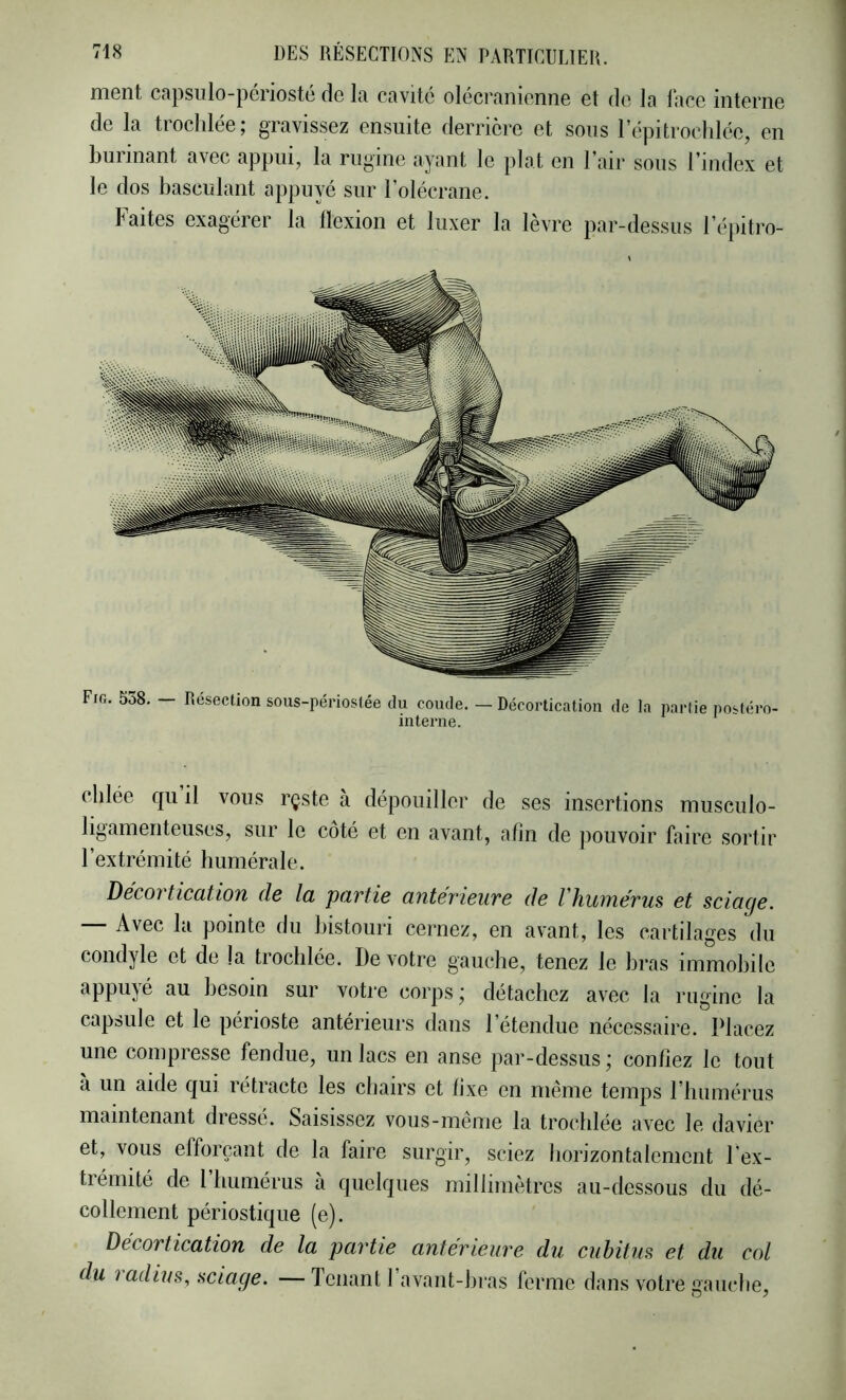 ment capsulo-périosté de la cavité olécranienne et de la lace interne de la trochlée ; gravissez ensuite derrière et sous répitroclilée, en burinant avec appui, la rugine ayant le plat en l’air sous l’index et le dos basculant appuyé sur l’olécrane. Faites exagérer la llexion et luxer la lèvre par-dessus l’épitro- Fig. 538. Résection sous-périoslée du coude. — Décortication de la partie j)ostéro- interne. chiée qu il vous rçste à dépouiller de ses insertions musculo- ligamenteuses, sur le côté et en avant, afin de pouvoir fiiire sortir l’extrémité humérale. Decoî ticcitiou de la pavtie anterieuve de Vhuïiiérus et sciage. Avec Iti pointe du bistouri cernez, en avant, les cartilages du condyle et de la trochlée. De votre gauche, tenez le bras immobile besoin sur votre corps j détachez avec la rugine la capsule et le périoste antérieurs dans 1 étendue nécessaire. Placez une compresse fendue, un lacs en anse par-dessus; confiez le tout a un aide qui rétracte les chairs et fixe en même temps riiumérus maintenant dressé. Saisissez vous-même la trochlée avec le davier et, vous efforçant de la faire surgir, sciez horizontalement l'ex- trémité de 1 humérus à quelques millimètres au-dessous du dé- collement périostique (e). Décortication de la pavtie anterieure du cubitus et du col du ladius, sciage. —Tenant 1 avant-bras ferme dans votre gauche.