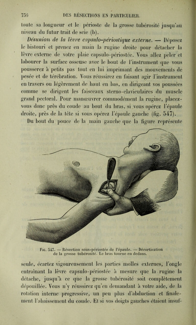 toute sa longueur et le périoste de la grosse tubérosité jusqu’au niveau du futur trait de scie (b). désunion de la lèvre capsido-périostique externe. — Déposez le bistouri et prenez en main la rugine droite pour ilétacber la lèvre externe de votre plaie capsulo-périostée. Vous allez peler et labourer la surface osseuse avec le bout de rinstrument que vous pousserez à petits pas tout en lui imprimant des mouvements de pesée et de térébration. Vous réussirez en bdsant agir rinstrument en travers ou légèrement de haut en bas, en dirigeant vos poussées comme se dirigent les faisceaux sterno-claviculaires du muscle grand pectoral. Pour manœuvrer commodément la rugine, placez- vous donc près du coude au bout du bras, si vous opérez l’épaule droite, près de la tète si vous opérez l’épaule gauche (fig. 547). Du bout du pouce de la main gauebe que la figure représente Fig. oT7. — Résection sous-periostée de l’épaule. — Décortication de la grosse tubérosité. Le bras tourne eu dedans. seule, écartez vigoureusement les parties molles externes, l’ongle entraînant la lèvre capsulo-périostée à mesure que la rugine la détache, jusqu’à ce que la grosse tubérosité soit complètement dépouillée. Vous n’y réussirez qu’en demandant à votre aide, de ht rotation interne progressive, un peu plus d’abduction et finale- ment l’abaissement du coude. Et si vos doigts gauches étaient insuf-