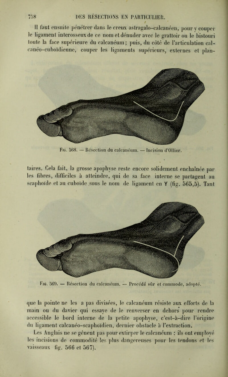 Il Riut ensuite pénétrer dans le creux astragalo-caleanéeu, pour y coupel- le ligament interosseux de ce nom et dénuder avec le grattoir ou le bistouri toute la face supérieure du calcanéum; puis, du côté de l’articulation cal- canéo-cuboïdienne, couper les ligaments supérieurs, externes et plan- taires. Cela fait, la grosse apophyse reste encore solidement enchaînée par les fihres, difficiles à atteindre, qui de sa face interne se partagent an scaphoïde et au cuboïde sous le nom de ligament en Y (fig. 565,5). Tant que la pointe ne les a pas divisées, le calcanéum résiste aux efforts de la main ou du davier qui essaye de le renverser en dehors pour rendre accessible le bord interne de la petite apophyse, c’est-à-dire l’origine du ligament calcanéo-scaphoidien, dernier obstacle à l’extraction. Les Anglais ne se gênent pas pour extirper le calcanéum : ils ont employé les incisions de commodité les plus dangereuses pour les tendons et les vaisseaux fig. 566 et 567).