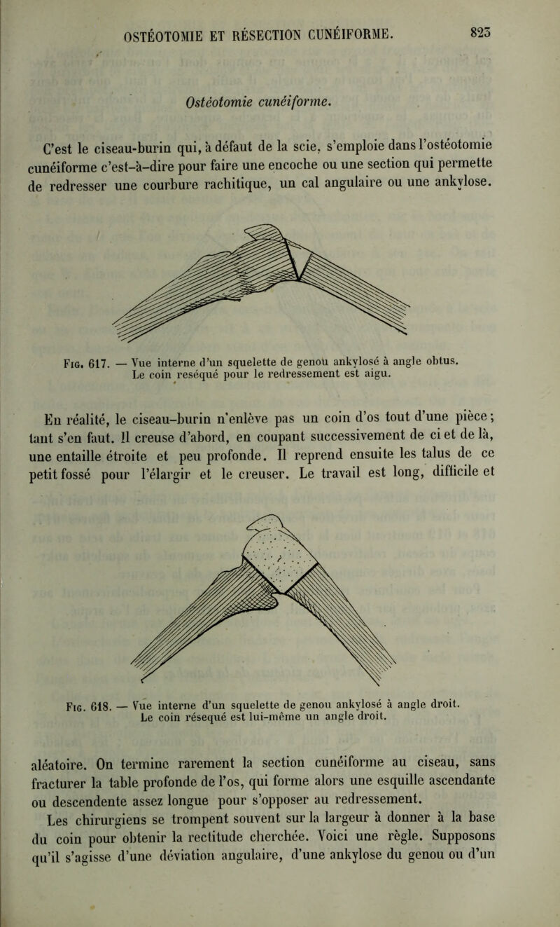 Ostéotomie cunéiforme. C’est le ciseau-burin qui, à défaut de la scie, s’emploie dans l’ostéotomie cunéiforme c’est-a-dire pour faire une encoche ou une section qui permette de redresser une courbure rachitique, un cal angulaire ou une ankylosé. Fig. 617. — Vue interne d’un squelette de genou ankylosé à angle obtus. Le coin réséqué pour le redressement est aigu. En réalité, le ciseau-burin n’enlève pas un coin d’os tout d’une pièce ; tant s’en faut. Il creuse d’abord, en coupant successivement de ci et de là, une entaille étroite et peu profonde. Il reprend ensuite les talus de ce petit fossé pour l’élargir et le creuser. Le travail est long, difficile et Fig. 618. — Vue interne d’un squelette de genou ankylosé à angle droit. Le coin réséqué est lui-même un angle droit. aléatoire. On termine rarement la section cunéiforme au ciseau, sans fracturer la table profonde de l’os, qui forme alors une esquille ascendante ou descendente assez longue pour s’opposer au redressement. Les chirurgiens se trompent souvent sur la largeur à donner à la base du coin pour obtenir la rectitude cherchée. Voici une règle. Supposons qu’il s’agisse d’une déviation angulaire, d’une ankylosé du genou ou d’un