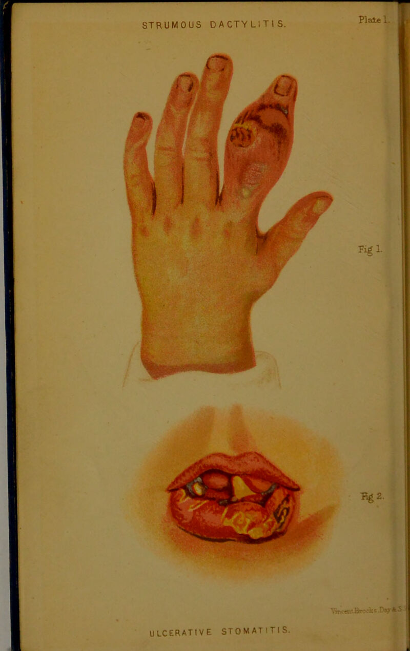 • % Vb«itAocik* D»9r*s I ULCERATIVE STOMATITIS. a