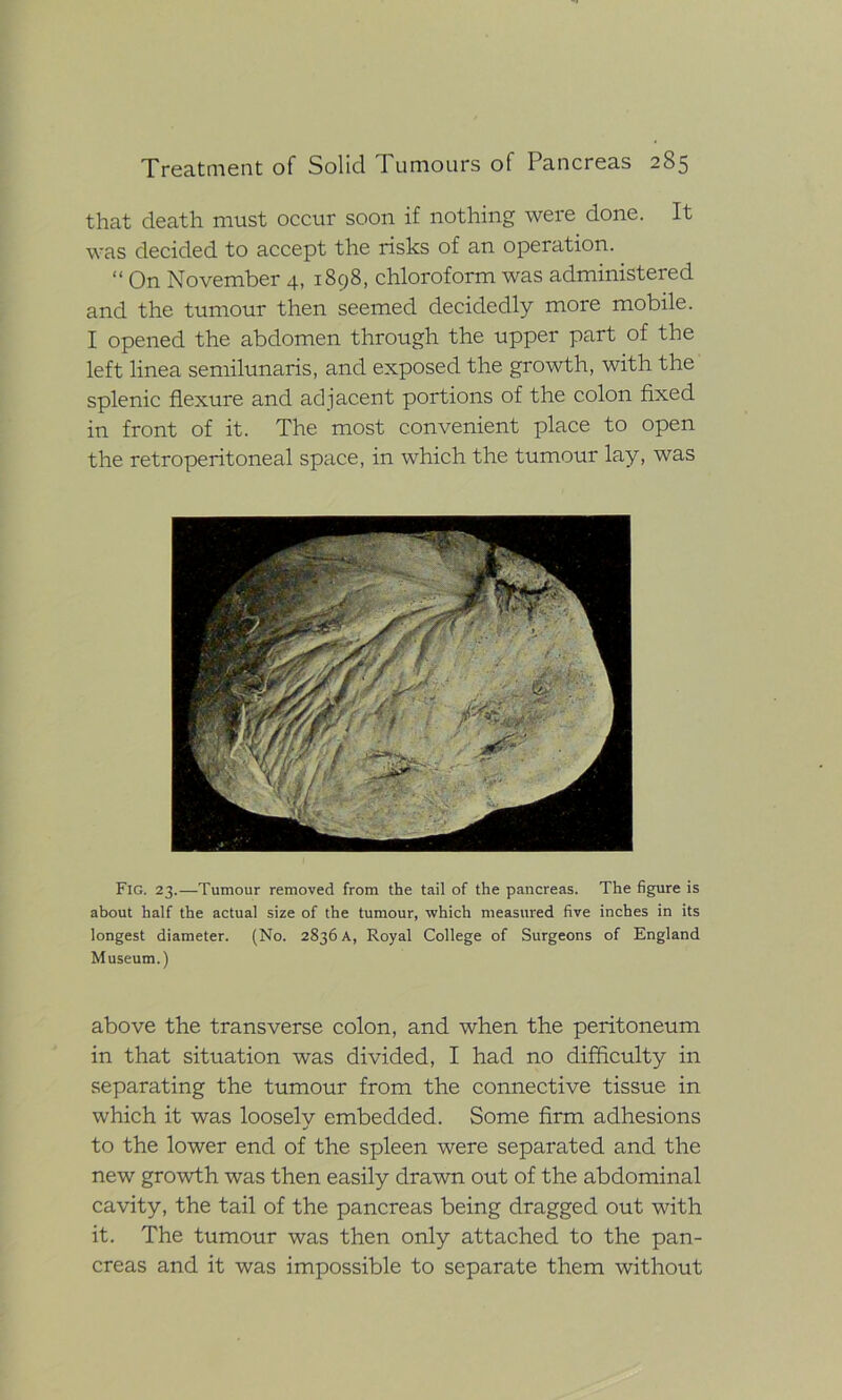 that death must occur soon if nothing were done. It was decided to accept the risks of an operation. “ On November 4, 1898, chloroform was administered and the tumour then seemed decidedly more mobile. I opened the abdomen through the upper part of the left linea semilunaris, and exposed the growth, with the splenic flexure and adjacent portions of the colon fixed in front of it. The most convenient place to open the retroperitoneal space, in which the tumour lay, was Fig. 23.—Tumour removed from the tail of the pancreas. The figure is about half the actual size of the tumour, which measured five inches in its longest diameter. (No. 2836 A, Royal College of Surgeons of England Museum.) above the transverse colon, and when the peritoneum in that situation was divided, I had no difficulty in separating the tumour from the connective tissue in which it was loosely embedded. Some firm adhesions to the lower end of the sjdeen were separated and the new growth was then easily drawn out of the abdominal cavity, the tail of the pancreas being dragged out with it. The tumour was then only attached to the pan- creas and it was impossible to separate them without