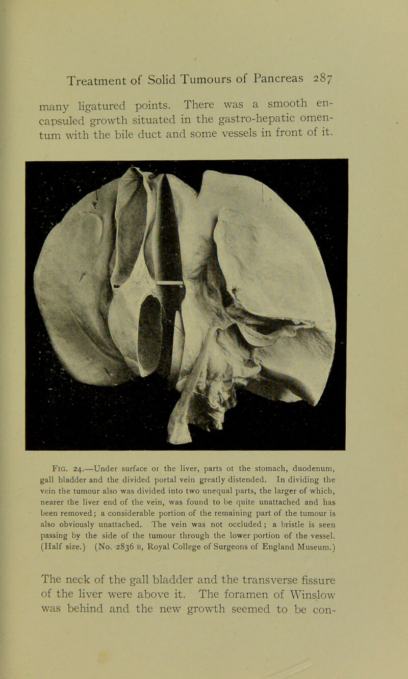 many ligatured points. There was a smooth en- eapsuled growth situated in the gastro-liepatic omen- tum with the bile duct and some vessels in front of it. Fig. 24.—Under surface or the liver, parts ot the stomach, duodenum, gall bladder and the divided portal vein greatly distended. In dividing the vein the tumour also was divided into two unequal parts, the larger of which, nearer the liver end of the vein, was found to be quite unattached and has been removed; a considerable portion of the remaining part of the tumour is also obviously unattached. The vein was not occluded ; a bristle is seen passing by the side of the tumour through the lower portion of the vessel. (Half size.) (No. 2836 B, Royal College of Surgeons of England Museum.) The neck of the gall bladder and the transverse fissure of the liver were above it. The foramen of Winslow was behind and the new growth seemed to be con-