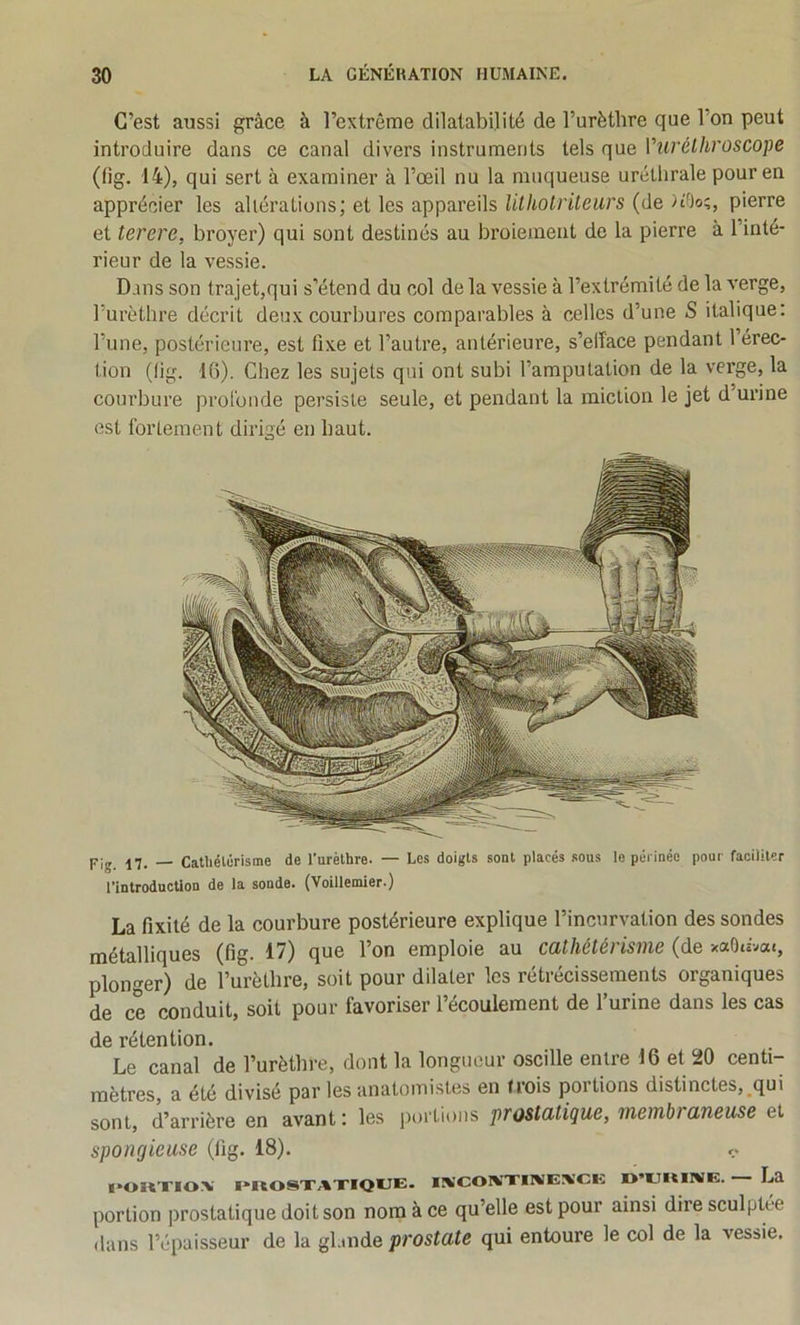 C’est aussi grâce à l’extrême dilatabilité de l’urèthre que l’on peut introduire dans ce canal divers instruments tels que Vurélhroscope (fig. 14), qui sert à examiner à l’œil nu la muqueuse uréthrale pour en apprécier les altérations; et les appareils lilhotriteurs (de pierre et terere, broyer) qui sont destinés au broiement de la pierre à l’inté- rieur de la vessie. Dans son trajet,qui s’étend du col de la vessie à l’extrémité de la x'erge, Turèthre décrit deux courbures comparables à celles d’une S italique: l’une, postérieure, est fixe et l’autre, antérieure, s’elîace pendant 1 érec- tion (lig. 16). Chez les sujets qui ont subi l’amputation de la verge, la courbure profonde persiste seule, et pendant la miction le jet d’urine est fortement dirigé en haut. pig -17. — Catliélérisme de l'urèthre. — Les doigts sont placés sous le périnée pour faciliter l'introduction de la sonda. (Voillemier.) La fixité de la courbure postérieure explique l’incurvation des sondes métalliques (fig- 17) que l’on emploie au cûtî/iéfé/îsjuc (de xotOt«vat, plonger) de l’urèthre, soit pour dilater les rétrécissements organiques de ce conduit, soit pour favoriser l’écoulement de l’urine dans les cas de rétention. Le canal de l’urèthre, dont la longueur oscille entre 16 et 20 centi- mètres, a été divisé par les anatomistes en (rois portions distinctes,.qui sont, d’arrière en avant: les portions prostatique, membraneuse et spongieuse (fig. 18). l'oitxiox’ i»nosxAXiQUE. iRjcoivxiivExcE o’ïjïtirwE. La portion prostatique doit son nom à ce qu’elle est pour ainsi dire sculptée dans l’('paisseur de la gl.mde prostate qui entoure le col de la vessie.