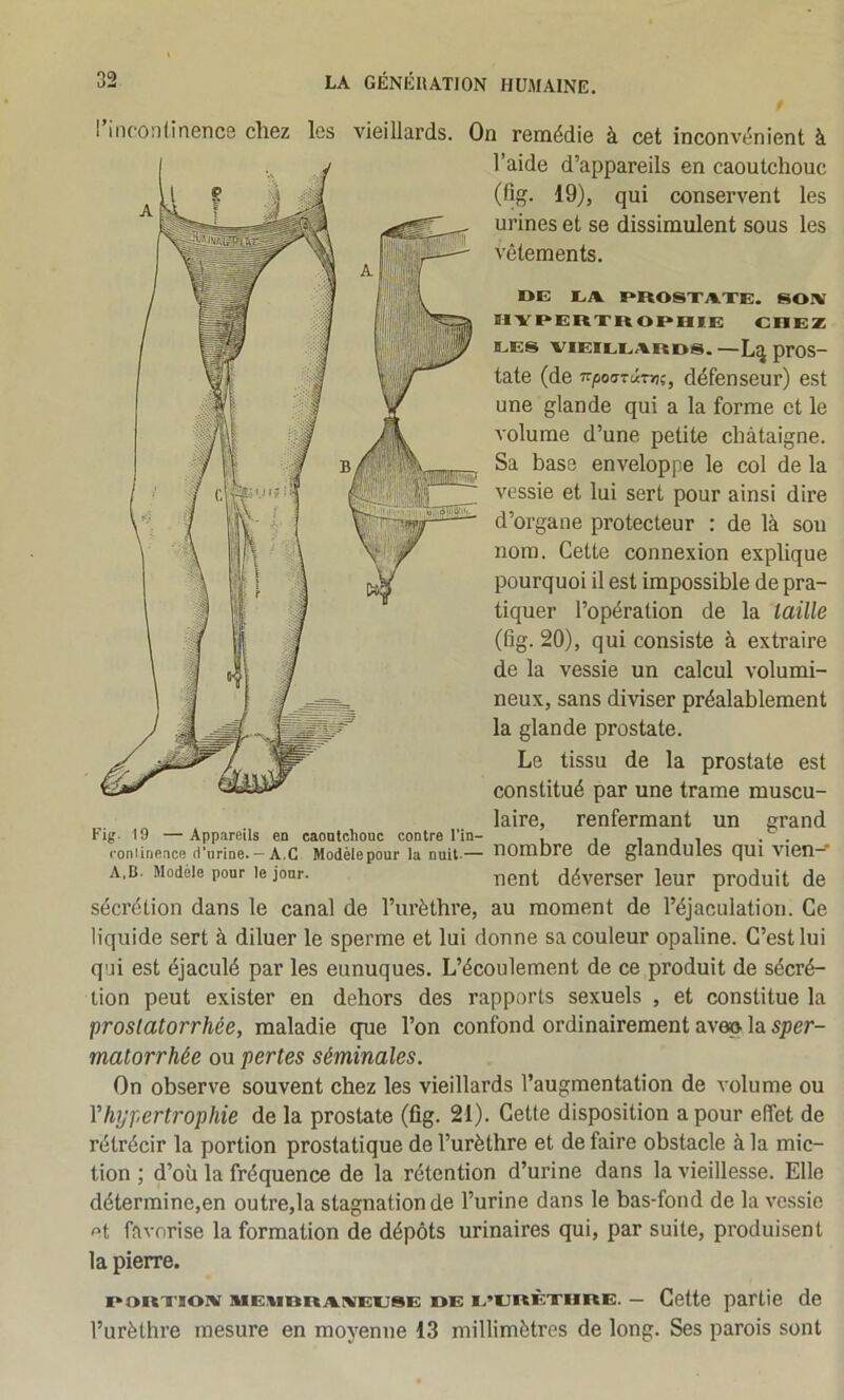 rinconlinence chez les vieillards. On remédie à cet inconvénient à l’aide d’appareils en caoutchouc (üg. 19), qui conservent les urines et se dissimulent sous les vêtements. DE EA DROSXAXE. SOA ÎIYDERXRODHIE CHEZ EES VIEIEEARDjS. —pTOS- tate (de T^posrû-mç, défenseur) est une glande qui a la forme et le volume d’une petite châtaigne. Sa base enveloppe le col de la vessie et lui sert pour ainsi dire d’organe protecteur : de là sou nom. Cette connexion explique pourquoi il est impossible de pra- tiquer l’opération de la taille (fig. 20), qui consiste à extraire de la vessie un calcul volumi- neux, sans diviser préalablement la glande prostate. Le tissu de la prostate est constitué par une trame muscu- laire, renfermant un grand Fig. 19 —Appareils en caoutchouc contre Fin- , , i j i • • ronlinence d'urine. — A.G Modèlepour la nuit-— T)0niDr6 C16 gla.ndul6S CJUl Vl6n— A,B. Modèle pour le jour. déverser leur produit de sécrétion dans le canal de l’urèthre, au moment de l’éjaculation. Ce liquide sert à diluer le sperme et lui donne sa couleur opaline. C’est lui qui est éjaculé par les eunuques. L’écoulement de ce produit de sécré- tion peut exister en dehors des rapports sexuels , et constitue la proslatorrhée, maladie que l’on confond ordinairement ave» la sper- matorrhée ou pertes séminales. On observe souvent chez les vieillards l’augmentation de volume ou Yhypertrophie de la prostate (fig. 21). Cette disposition a pour effet de rétrécir la portion prostatique de l’urèthre et de faire obstacle à la mic- tion ; d’où la fréquence de la rétention d’urine dans la vieillesse. Elle détermine,en outre,la stagnation de l’urine dans le bas-fond de la vessie et favorise la formation de dépôts urinaires qui, par suite, produisent la pierre. Doitxiom miEMDRAivEESE DE E’URÈxHRE. — Cette partie de l’urèthre mesure en moyenne 13 millimètres de long. Ses parois sont