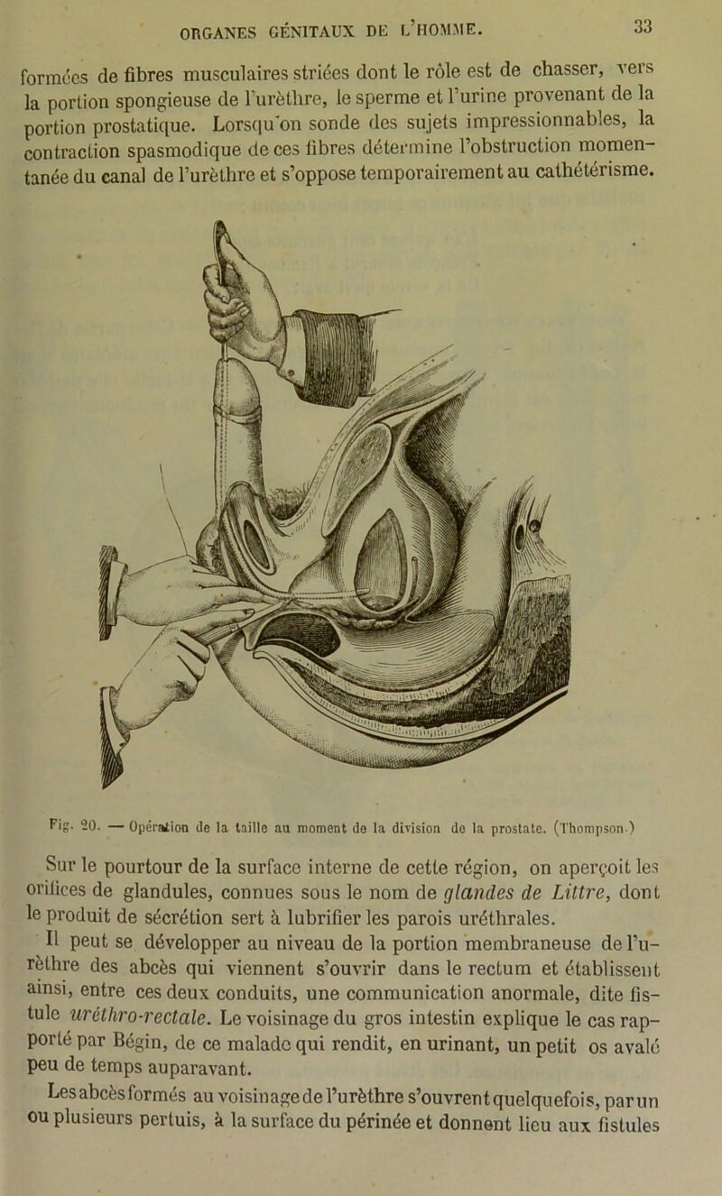 formées de fibres musculaires striées dont le rôle est de chasser, vers la portion spongieuse de Turèthre, le sperme et l’urine provenant de la portion prostatique. Lorscju on sonde des sujets impressionnables, la contraction spasmodique de ces fibres détermine l’obstruction momen- tanée du canal de Turèthre et s’oppose temporairement au cathétérisme. Fig. SO. — Opération de la taille au moment de la division de la prostate. (Thompson-) Sur le pourtour de la surface interne de cette région, on aperçoit les orifices de glandules, connues sous le nom de glandes de Littré, dont le produit de sécrétion sert à lubrifier les parois uréthrales. Il peut se développer au niveau de la portion membraneuse de l’u- rèthre des abcès qui viennent s’ouvrir dans le rectum et établissent ainsi, entre ces deux conduits, une communication anormale, dite fis- tule uréthro-rectale. Le voisinage du gros intestin explique le cas rap- porté par Bégin, de ce malade qui rendit, en urinant, un petit os avalé peu de temps auparavant. Les abcès formés au voisinagede l’urèthre s’ouvrent quelquefois, parun ou plusieurs pertuis, à la surface du périnée et donnent lieu aux fistules