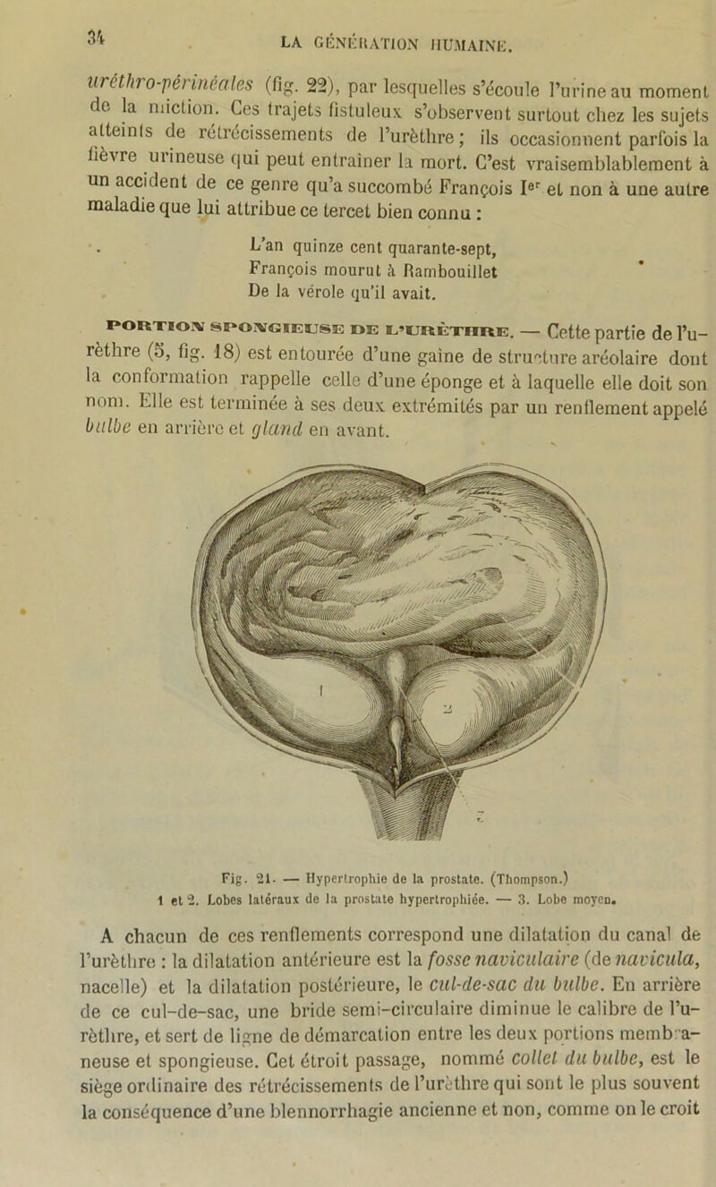 LA GÉNKIIAÏION IIUMAIXK, uréthro-pémiéales (fig. 22), par lesquelles s’écoule l’urine au moment G a miction. Ces trajets fistuleux s’observent surtout chez les sujets atteints de rétrécissements de l’urèthre ; ils occasionnent parfois la lièvre uiineuse qui peut entraîner la mort. C’est vraisemblablement à un accident de ce genre qu’a succombé François !«'’ et non à une autre maladie que lui attribue ce tercet bien connu : L’an quinze cent quarante-sept, François mourut à Rambouillet De la vérole qu’il avait. ^ PORTIO.-V SPOIVGIEKJSE DE E’URÈximE. — Cottc partie de l’u- rèthre (5, fig. 18) est entourée d’une gaine de structure aréolaire dont la conformation rappelle celle d’une éponge et à laquelle elle doit son nom. Elle est terminée à ses deux extrémités par un renflement appelé bulbe en arriérent gland en avant. Fig. 21. — Hypertrophie de la prostate. (Thompson.) 1 et 2. Lobes latéraux de la prostate hypertrophiée. — 3. Lobe moyen. A chacun de ces renflements correspond une dilatation du canal de l’urèthre : la dilatation antérieure est la fosse naviculaire (de navicula, nacelle) et la dilatation postérieure, le cul-de-sac du bulbe. En arrière de ce cul-de-sac, une bride semi-circulaire diminue le calibre de l’u- rèthre, et sert de ligne de démarcation entre les deux portions memb:a- neuse et spongieuse. Cet étroit passage, nommé collet du bulbe, est le siège orilinaire des rétrécissements de l’urèthre qui sont le plus souvent la conséquence d’une blennorrhagie ancienne et non, comme on le croit