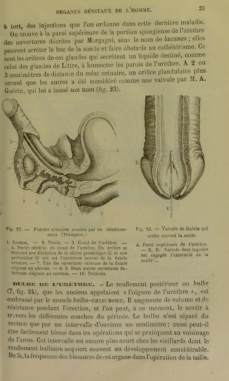 à tort, des iDjectious que l’on ordonne dans cette dernière maladie. On trouve à la paroi supérieure de la portion spongieuse de l’urèthre des ouvertures décrites par Morgagni, sous le nom de lacunes ; elles peuvent arrêter le bec de la sonde et faire obstacle au cathétérisme. Ce sont les orifices de ces glandes qui secrétent un liquide destiné, comme celui des glandes de Littré, à humecter les parois de l’urèthre. A 2 ou 3 centimètres de distance du méat urinaire, un orifice glandulaire plus accusé que les autres a été considéré comme une valvule par M. A. Guérin, qui lui a laissé son nom (tig. 23). Fig- 22. — Fislntes urinaires causées par un rétrécisse- Fig. 23. — Valvule de Guérin qui ment- (Thompson.) iU'rête souvent la sonde. 1. P.ectnm. — 2. Ves«ie. — 3. Canal de l’orethre. — -t. Partie rétrérie du canal de l’uréthre. En arriére se trouvent une dilatation de la région prostatique (5) et une perforation (6 qui est ronverlnro interne de la fistule urinaire. — 7. Une des ouvertures exterues de la fistule siégeant au périnée. — 8. 9. Deux autres ouvertures fis- tuleuses siégeant au scrotum. — 10. Testicule. mjLBE »E E’unÈXHRE. — Lc renflement postérieur ou bulbe (7, fig. 24), que les anciens appelaient « l’oignon de l’urèthre », est embrassé par le muscle bulbo-caveineux. Il augmente de volume et de résistance pendant l’érection, et l’on peut, à ce moment, le sentir à travers les différentes couches du périnée. Le bulbe n’est séparé du rectum que par un intervalle d’environ un centimètre ; aussi peut-il être facilement blessé dans les opérations qui se pratiquent au voisinage de l’anus. Cet intervalle est encore plus court chez les vieillards dont le renflement bulbaire acquiert souvent un développement considérable. De là, la fréquence des blessures de cet organe dans l’opération de la taille. A. Paroi supérieure de Furèthre. — B, D. Valvule dans laquelle est engagée l'eilrémilé do la sonde C.