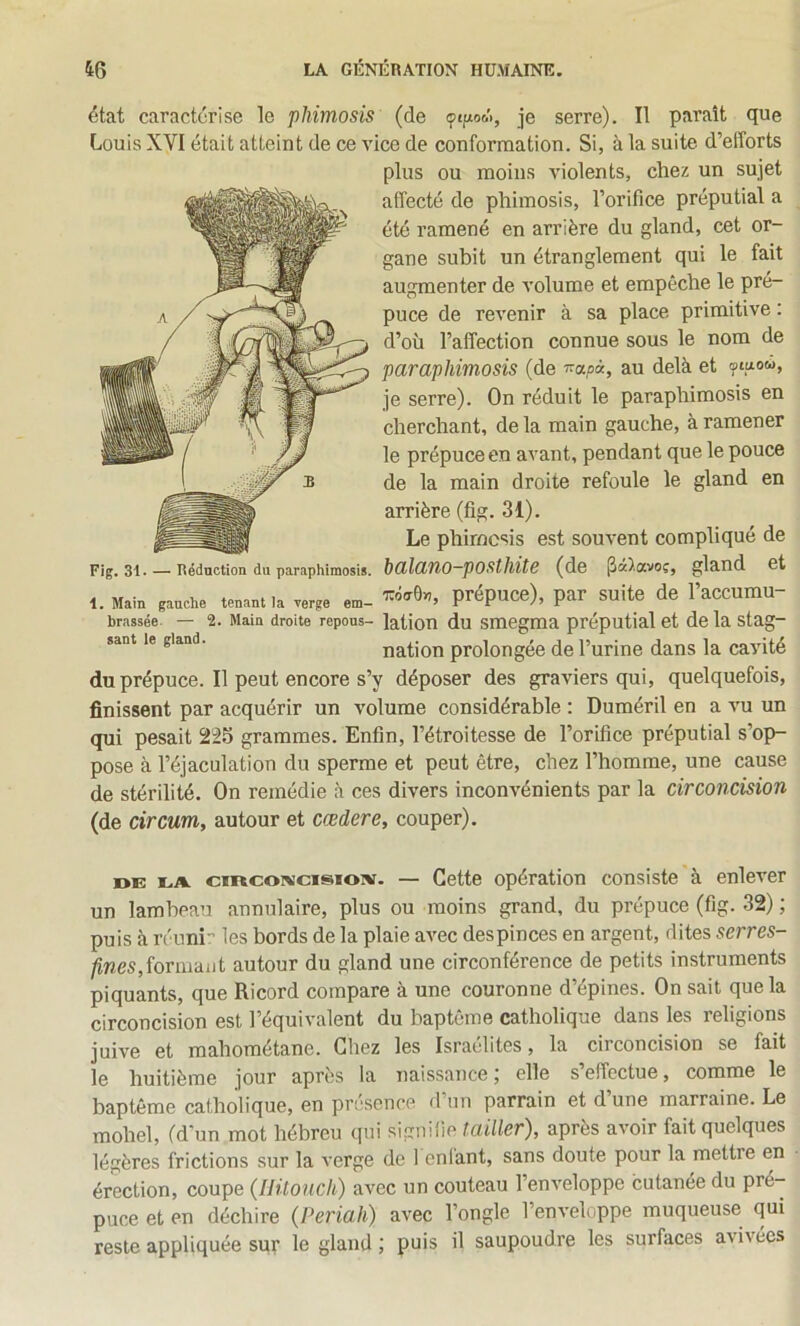 État caractérise le phimosis (de (pipow, je serre). Il paraît que Louis XVI était atteint de ce vice de conformation. Si, à la suite d’efforts plus ou moins violents, chez un sujet affecté de phimosis, l’orifice préputial a été ramené en arrière du gland, cet or- gane subit un étranglement qui le fait augmenter de volume et empêche le pré- puce de revenir à sa place primitive : d’où l’affection connue sous le nom de paraphimosis (de Tra/ià, au delà et tpi^ow, je serre). On réduit le paraphimosis en cherchant, de la main gauche, à ramener le prépuce en avant, pendant que le pouce de la main droite refoule le gland en arrière (fig. 31). Le phimosis est souvent compliqué de Fig. 31- — Réduction du paraphimosis. hdlttflO-pOSthitC (de j3a).avoc, gland et 1. Main gauche tenantia verge em- prépuce), par Suite de l’accumu- brassée. — 2. Main droite répons- latiou du smegma préputial et de la stag- sant le gland. nation prolongée de l’urine dans la cavité du prépuce. Il peut encore s’y déposer des graviers qui, quelquefois, finissent par acquérir un volume considérable ; Duméril en a vu un qui pesait 225 grammes. Enfin, l’étroitesse de l’orifice préputial s’op- pose à l’éjaculation du sperme et peut être, chez l’homme, une cause de stérilité. On remédie à ces divers inconvénients par la circoncision (de circum, autour et cœdere, couper). oE EA ciRcoiv’cisioiv. — Cette opération consiste à enlever un lambeau annulaire, plus ou moins grand, du prépuce (fig. 32) ; puis à réuni-’ les bords de la plaie avec despinces en argent, dites serres- fines,îovmaüt autour du gland une circonférence de petits instruments piquants, que Ricord compare à une couronne d’épines. On sait que la circoncision est l’équivalent du bapteme catholique dans les religions juive et mahométane. Chez les Israélites, la circoncision se fait le huitième jour après la naissance ; elle s’effectue, comme le baptême catholique, en présence d’un parrain et d’une marraine. Le mohel, (d’un mot hébreu qui signifie tailler), après avoir fait quelques légères frictions sur la verge de 1 enlant, sans doute pour la mettre en érection, coupe (llüonch) avec un couteau l’enveloppe cutanée du pré- puce et en déchire (Periah) avec l’ongle l’enveloppe muqueuse qui reste appliquée sur le gland ; puis il saupoudre les surfaces avivées