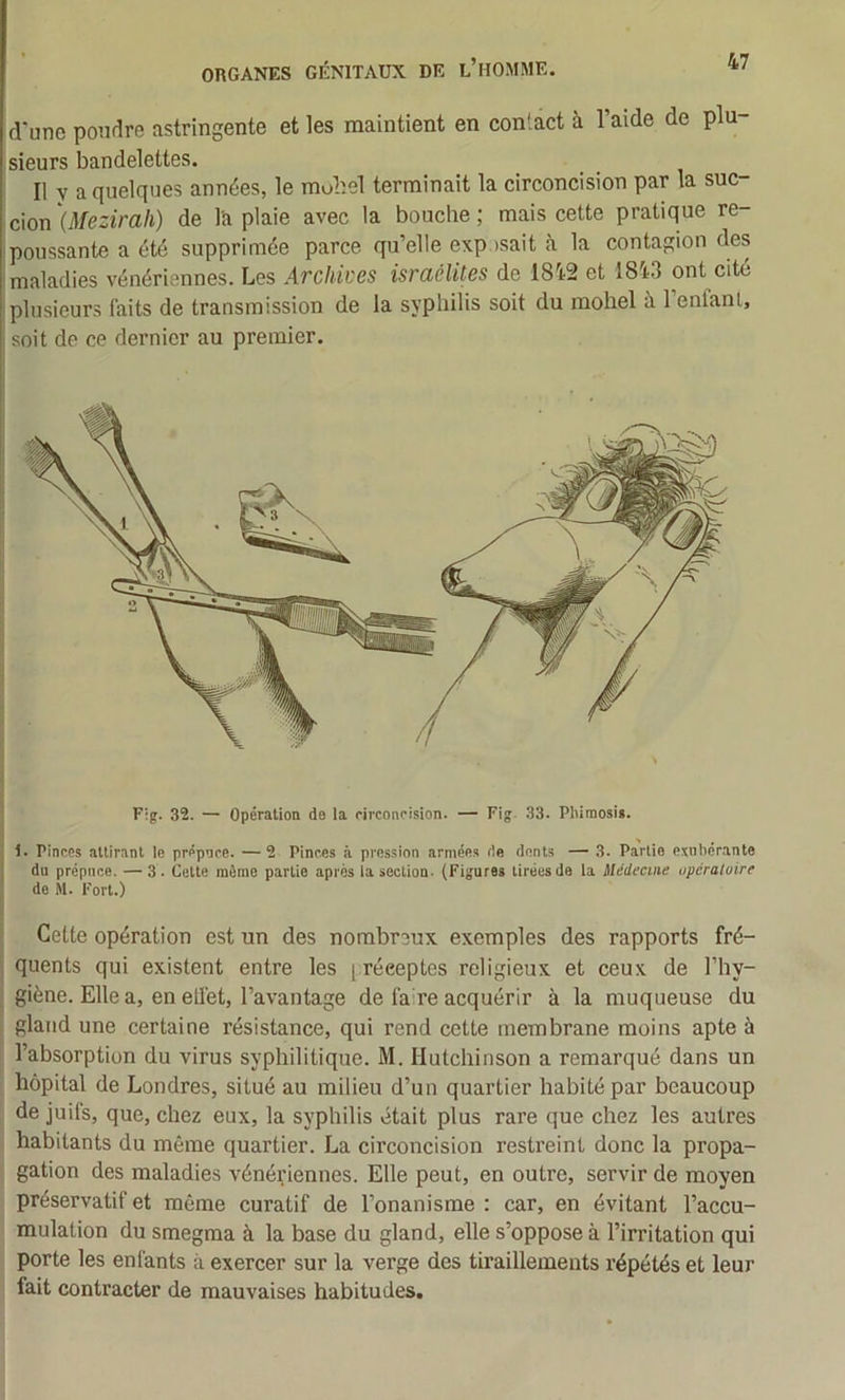 d'une pondre astringente et les maintient en conlact à l’aide de plu- sieurs bandelettes. Il y a quelques années, le mohel terminait 1a circoncision par la suc- cion '{Mezirah) de l'a plaie avec la bouche ; mais cette pratique re- poussante a été supprimée parce, qu’elle exp isait à la contagion des maladies vénériennes. Les Archives israélites de 1812 et 1843 ont cité plusieurs faits de transmission de la syphilis soit du mohel à 1 enfant, soit do ce dernier au premier. F;g. 32. — Opératioa de la circoncision. — Fig 33. Pliimosig. 1. rinces alliranl le prépnee. —2 Pinces à pression armées rie dents — 3. Partie exnliérante du prépuce. — 3. Cette même partie après la section. (Figures tirées de la Médecine opératoire de M. Fort.) Cette opération est un des nombreux exemples des rapports fré- quents qui existent entre les | réeeptes religieux et ceux de l’hy- giène. Elle a, en elfet, l’avantage de faire acquérir à la muqueuse du gland une certaine résistance, qui rend cette membrane moins apte à l’absorption du virus syphilitique. M. Hutchinson a remarqué dans un hôpital de Londres, situé au milieu d’un quartier habité par beaucoup de juifs, que, chez eux, la syphilis était plus rare que chez les autres habitants du même quartier. La circoncision restreint donc la propa- gation des maladies vénériennes. Elle peut, en outre, servir de moyen préservatif et même curatif de l’onanisme : car, en évitant l’accu- mulation du smegma à la base du gland, elle s’oppose à l’irritation qui porte les enfants à exercer sur la verge des tiraillements répétés et leur fait contracter de mauvaises habitudes.
