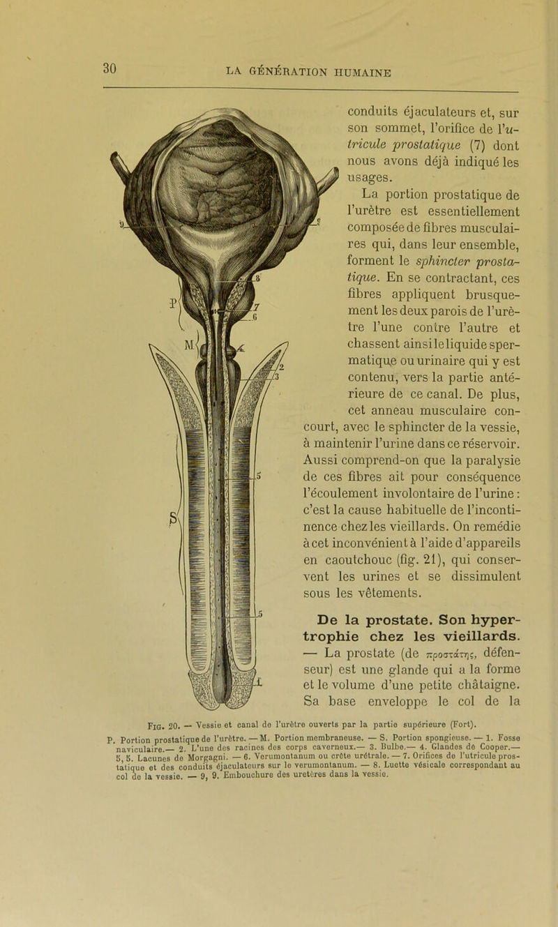 conduits éjaculateurs et, sur son sommet, l’orifice de l’ii- tricule prostatique (7) dont nous avons déjà indiqué les usages. La portion prostatique de l’urètre est essentiellement composée de fibres musculai- res qui, dans leur ensemble, forment le sphincter prosta- tique. En se contractant, ces fibres appliquent brusque- ment les deux parois de l’urè- tre l’une contre l’autre et chassent ainsi le liquide sper- matique ou urinaire qui y est contenu, vers la partie anté- rieure de ce canal. De plus, cet anneau musculaire con- court, avec le sphincter de la vessie, à maintenir l’urine dans ce réservoir. Aussi comprend-on que la paralysie de ces fibres ait pour conséquence l’écoulement involontaire de l’urine : c’est la cause habituelle de l’inconti- nence chez les vieillards. On remédie à cet inconvénient à l’aide d’appareils en caoutchouc (fig. 21), qui conser- vent les urines et se dissimulent sous les vêtements. De la prostate. Son hyper- trophie chez les vieillards. — La prostate (de -pod-â-rj)?, défen- seur) est une glande qui a la forme et le volume d’une petite châtaigne. Sa base enveloppe le col de la Fig. 20. — Veflsio et canal do l’urètre ouverts par la partie supérieure (Fort). P. Portion prostatique de l’urètre.—M. Portion membraneuse. — S. Portion spongieuse. — 1. Fosse naviculaire. 2. L’une des racines des corps caverneux.— 3. Bulbe.— 4. Glandes dè Coopor.— 5 5. Lacunes do Morgagni. — 6. Vorumontanum ou crête urétralo. — 7. Orifices do l’utriculo pros- tatique et des conduits éjaculateurs sur le vorumontanum. — 8. Luette vésicale correspondant au col do la vessie. — 9, 9. Embouchure des uretères dans la vessie.