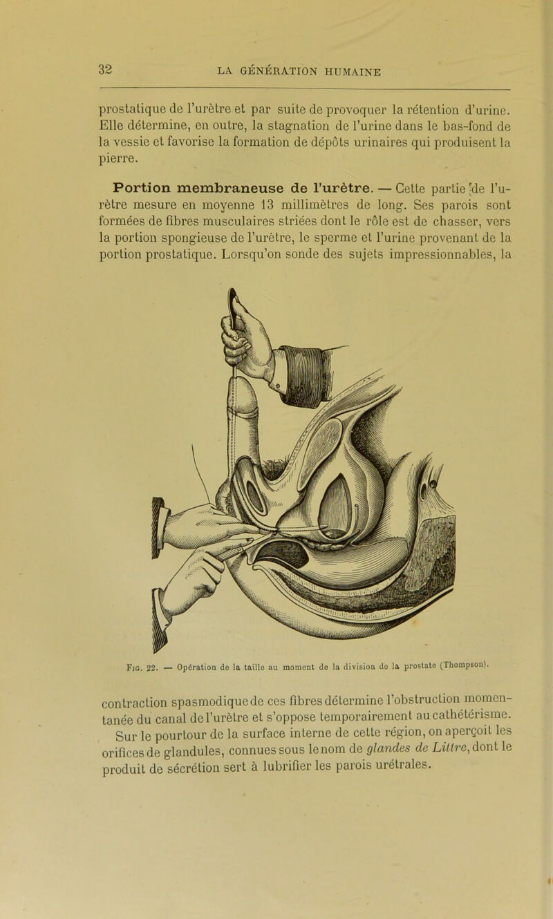 prostatique de l’urètre et par suite de provoquer la rétention d’urine. Elle détermine, en outre, la stagnation de l’urine dans le bas-fond de la vessie et favorise la formation de dépôts urinaires qui produisent la pierre. Portion membraneuse de l’urètre. — Cette partie ^^e l’u- rètre mesure en moyenne 13 millimètres de long. Ses parois sont formées de fibres musculaires striées dont le rôle est de chasser, vers la portion spongieuse de l’urètre, le sperme et l’urine provenant de la portion prostatique. Lorsqu’on sonde des sujets impressionnables, la Fio. 22. — Opération do la taille au moment do la division do la prostate (Thompson). contraction spasmodique de ces fibres détermine l’obstruction momen- tanée du canal de l’urètre et s’oppose temporairement au cathétérisme. Sur le pourtour de la surface interne de cette région, on aperçoit les orifices de glandules, connues sous le nom de glandes de LzV^re, dont le produit de sécrétion sert à lubrifier les parois urétiales.