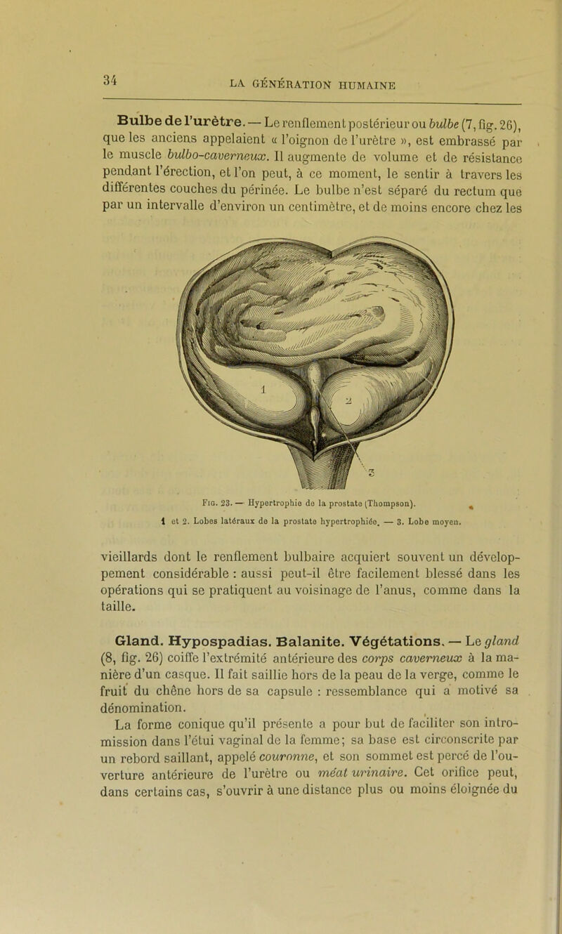 Bulbe de l’urètre. — Le renflement postérieur ou bulbe (7, fig. 26), que les anciens appelaient a l’oignon de l’urètre », est embrassé par le muscle bulbo-cavernmx. Il augmente de volume et de résistance pendant l’érection, et l’on peut, à ce moment, le sentir à travers les différentes couches du périnée. Le bulbe n’est séparé du rectum que par un intervalle d’environ un centimètre, et de moins encore chez les Fig. 23. — Hypertrophio de la prostate (Thompson). ^ 1 et 2. Lobes latéraux do la prostate hypertrophiée. — 3. Lobe moyen, vieillards dont le renflement bulbaire acquiert souvent un dévelop- pement considérable : aussi peut-il être facilement blessé dans les opérations qui se pratiquent au voisinage de l’anus, comme dans la taille. Gland. Hypospadias. Balanite. Végétations. — ht gland (8, fig. 26) coiffe l’extrémité antérieure des corps caverneux à la ma- nière d’un casque. Il fait saillie hors de la peau de la verge, comme le fruit du chêne hors de sa capsule : ressemblance qui a motivé sa dénomination. La forme conique qu’il présente a pour but de faciliter son intro- mission dans l’étui vaginal de la femme; sa base est circonscrite par un rebord saillant, appelé couronne^ et son sommet est percé de l’ou- verture antérieure de l’urètre ou méat urinaire. Cet orifice peut, dans certains cas, s’ouvrir à une distance plus ou moins éloignée du