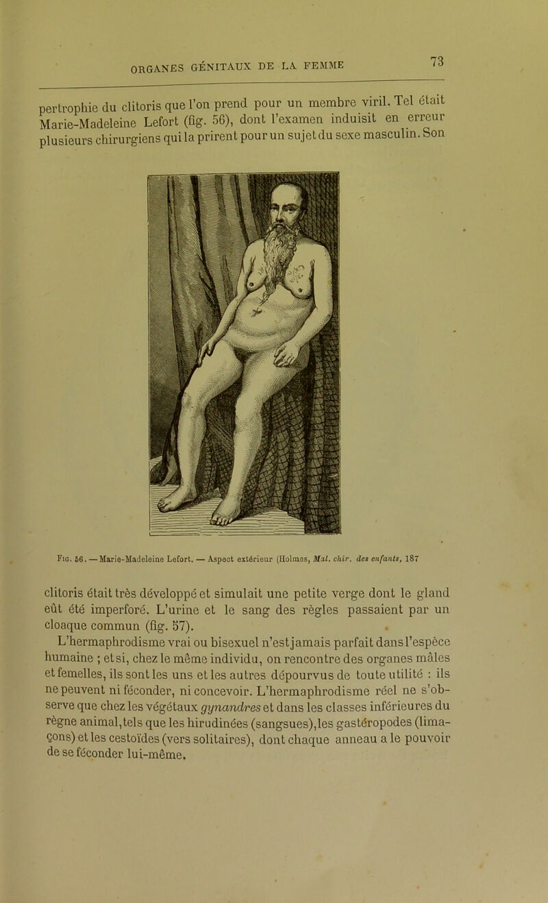 perlrophie du clitoris que l’on prend pour un membre viril. Tel était Marie-Madeleine Lefort (fig. 56), dont l’examen induisit en erreur plusieurs chirurgiens qui la prirent pour un sujet du sexe masculin. Son Fig. Ô6.-~Marie-MadeleIno Lefort. —• Aspect extérieur (Holmes, Mal. chir. des enfants, 187 clitoris était très développé et simulait une petite verge dont le gland eût été imperforé. L’urine et le sang des règles passaient par un cloaque commun (fig. 57). L’hermaphrodisme vrai ou bisexuel n’est j amais parfait dans l’espèce humaine ; et si, chez le même individu, on rencontre des organes mâles et femelles, ils sont les uns et les autres dépourvus de touteutilité : ils ne peuvent ni féconder, ni concevoir. L’hermaphrodisme réel ne s’ob- serve que chez les végétaux gynandres et dans les classes inférieures du règne animal,tels que les hirudinées (sangsues),les gastéropodes (lima- çons) et les cestoïdes (vers solitaires), dont chaque anneau a le pouvoir de se féconder lui-même.