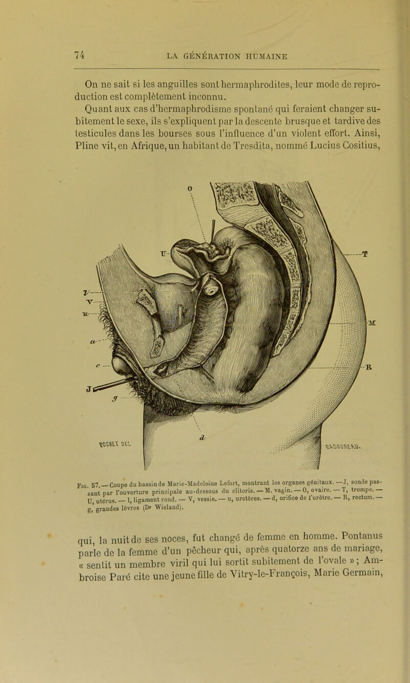 On ne sait si les anguilles sont hermaphrodites, leur mode de repro- duction est complètement inconnu. Quant aux cas d’hermaphrodisme spontané qui feraient changer su- bitement le sexe, ils s’expliquent par la descente brusque et tardive des testicules dans les bourses sous l’inüuence d’un violent effort. Ainsi, Pline vit, en Afrique, un habitant de Trcsdita, nommé Lucius Cositius, Fig. S7. —Coupe du bassinde Mario-Madeleine Lefort, monlrant les organes génitaux.—J, sonde pas- sant par l’ouverture principale au-dessous du clitoris. — M. vagin. — 0, ovaire. T, trompe. U, utérus. — 1, ligament rond. — V, vessie. — u, uretères. — d, orifice do l’urôtro. — R, rectum. — g,’ grandes lèvres (Dr Wioland). qui, la nuit de ses noces, fut changé de femme en homme. Pontanus parle de la femme d’un pêcheur qui, après quatorze ans de mariage, « sentit un membre viril qui lui sortit subitement de 1 ovale » , Am- broise Paré cite une jeune fdle de Vitry-le-François, Marie Germain,