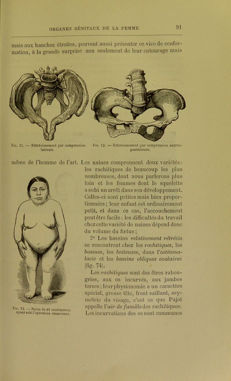 mais aux hanches étroites, peuvent aussi présenter ce vice de confor- mation, à la grande surprise non seulement de leur entourage mais Fig. 71. — Rétrécissement par compression Fig. 72. — Rétrécissement par compression antéro- latérale. postérieure. même de l’homme de l’art. Les naines comprennent deux variétés : les rachitiques de beaucoup les plus nombreuses, dont nous parlerons plus loin et les femmes dont le squelette a subi un arrêt dans son développement. Celles-ci sont petites mais bien propor- tionnées ; leur enfant est ordinairement petit, et dans ce cas, l’accouchement peutêtre facile: les diffîcultésdu travail chez cette variété de naines dépend donc du volume du fœtus ; 2® Les bassins relativement rétrécis se rencontrent chez les rachitiques^ les bossues, les boiteuses, dans Y ostéoma- lacie et les bassins obliques ovalaires (fig. 74). Les rachitiques sont des êtres rabou- gries, aux os incurvés, aux jambes torses ; leur physionomie a un caractère spécial, grosse tête, front saillant, asy- métrie du visage, c’est ce que Pajot F.O. 73. - Naine de D7 centimètres famille deS racllitiqueS. ayant subi l’opération césarienne. LeS inCUrvatioUS deS OS SOllt COmmUlieS